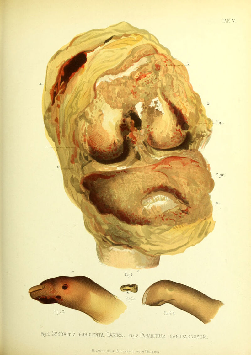 %1. SyNOVITIS PURULEN TA. C ARIES % x. PaNARITIUM GANGRAE N 0 SUM. H.Laupp'sche Buchhandlung in Tübingen.