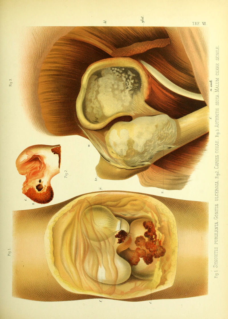 TAF. YT Fiji Synovitis purulenta.Gonitis ulcerosa. Fi52. Caries coxae. %,3.Arthritis sicca.Malum coxae senile.