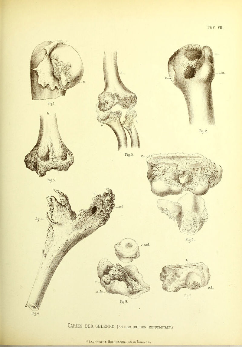 Cäries DER GELENKE (an der oberen extremitaet.) H.Laupp’sche Buchhandlung in Tübingen.