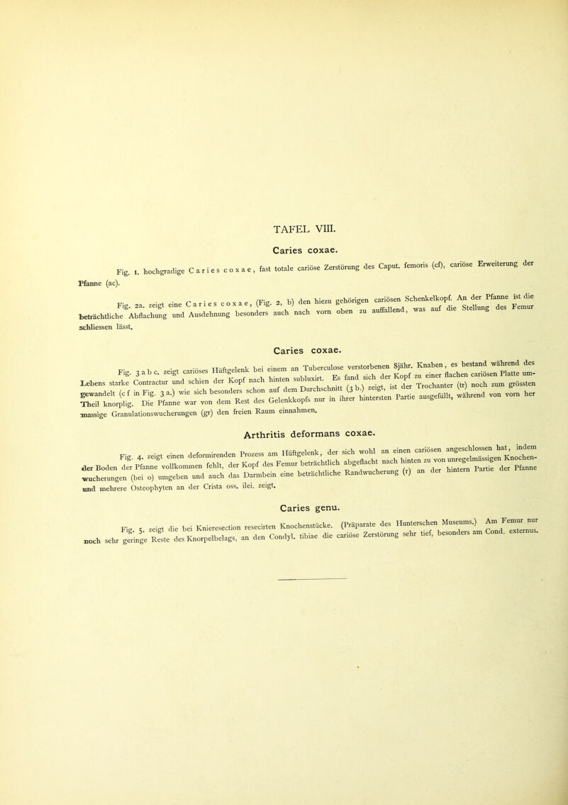 Caries coxae. Fig. i. hochgradige Caries coxae, Pfanne (ac). fast totale cariöse Zerstörung des Caput, femoris (cf), cariöse Erweiterung der Fig. 2a. zeigt eine Caries coxae, (Fig. 2, b) den hiezu gehörigen cariösen beträchtliche Abflachung und Ausdehnung besonders auch nach vorn oben zu auffallen schliessen lässt. Schenkelkopf. An der Pfanne ist die was auf die Stellung des Femur Caries coxae. Fi„ 3 ab c. zeig. cariöses H«*** bei »em “T,“ £’ Z Lebens starke Contractur und schien der Kopf nac r m e , . . . . , Trochanter (tr) noch zum grössten ——- - massige Granulationswucherungen (gr) den freien Raum emnahmen. Arthritis deformans coxae. Fig. 4. zeigt einen deform!,ende« Pro,» a» Hüftgelenk, de, sieh wohl an einen cariösen angesehlo^n ha^, jndem der Boden ZLJ, ollkonnnen feh.t, de, Kopf des Ferne, beträchtlich P^TdS ■Wucherungen (bei o) umgeben und auch das Darmbein eine beträchtliche Randwucherung (r) an und mehrere Osteopliyten an der Crista oss. ilei. zeigt. Caries genu. Fig. s. zeigt di« bei Knieresection resecir.en KnoehensUieke. (Präparate des ““'L ZIZZZ noch sehr geringe Reste des Knorpelbelags, an den Cond,,, tibiae di, cariöse Zerstörung sehr t.ef, besonders am Cond.