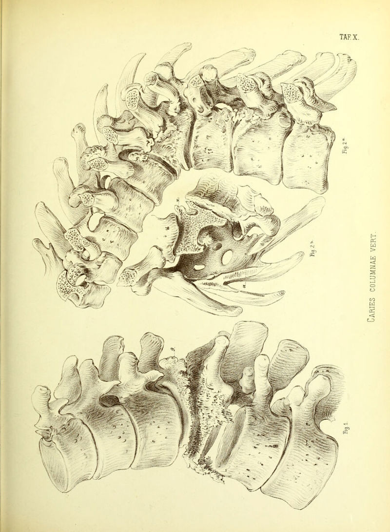 Caries columnae vert.