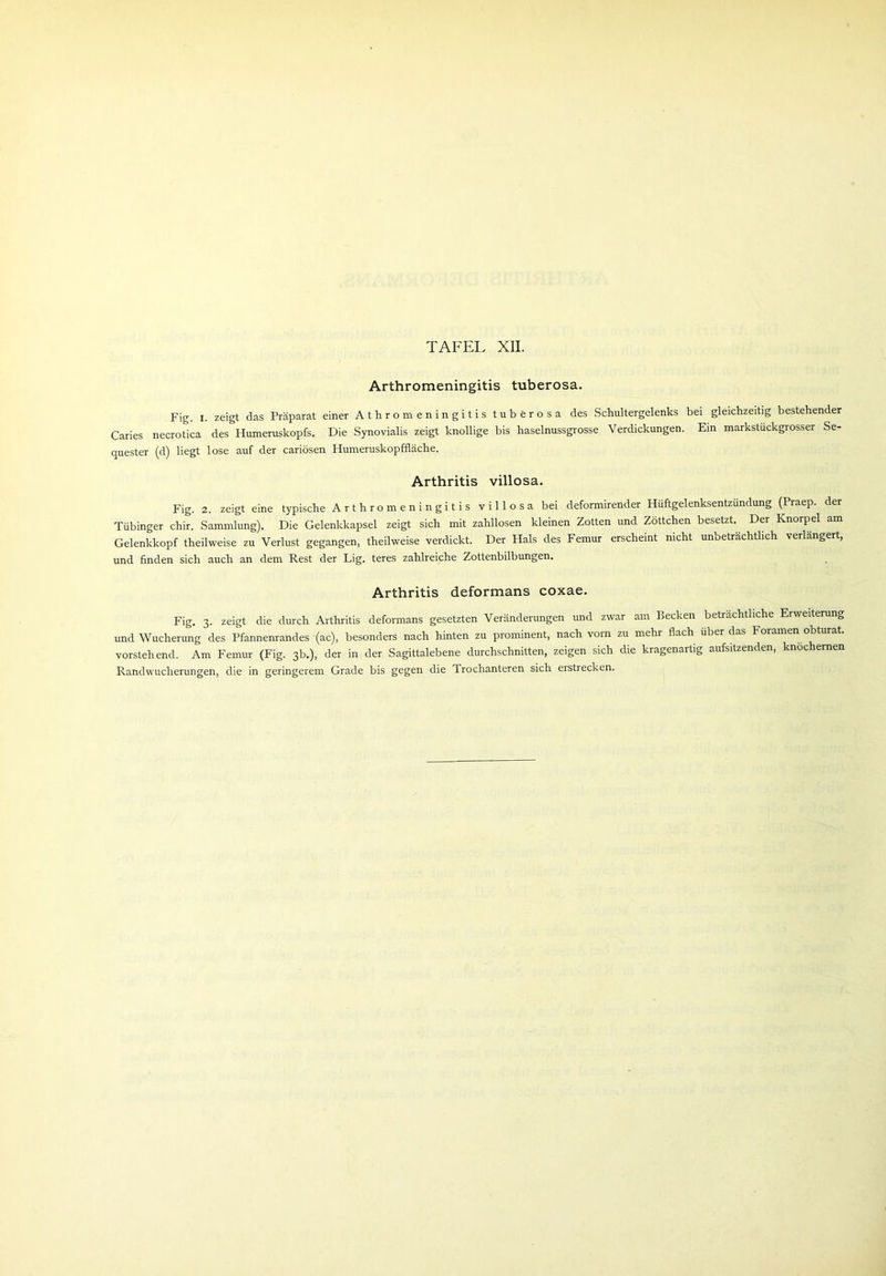 Arthromeningitis tuberosa. Fig. I. zeigt das Präparat einer Athrom eningitis tuberosa des Schultergelenks bei gleichzeitig bestehender Caries necrotica des Humeruskopfs. Die Synovialis zeigt knollige bis haselnussgrosse Verdickungen. Ein markstuckgrosser Se- quester (d) liegt lose auf der cariösen Humeruskopffläche. Arthritis villosa. Fig. 2. zeigt eine typische Arthromeningitis villosa bei deformirender Hüftgelenksentzündung (Praep. der Tübinger chir. Sammlung). Die Gelenkkapsel zeigt sich mit zahllosen kleinen Zotten und Zöttchen besetzt. Der Knorpel am Gelenkkopf theilweise zu Verlust gegangen, theilweise verdickt. Der Hals des Femur erscheint nicht unbeträchtlich verlängert, und finden sich auch an dem Rest der Lig. teres zahlreiche Zottenbilbungen. Arthritis deformans coxae. Fig. 3. zeigt die durch Arthritis deformans gesetzten Veränderungen und zwar am Becken beträchtliche Erweiterung und Wucherung des Pfannenrandes (ac), besonders nach hinten zu prominent, nach vorn zu mehr flach über das Foramen obturat. vorstehend. Am Femur (Fig. 3b.), der in der Sagittalebene durchschnitten, zeigen sich die kragenartig aufsitzenden, knöchernen Randwucherungen, die in geringerem Grade bis gegen die Trochanteren sich erstrecken.