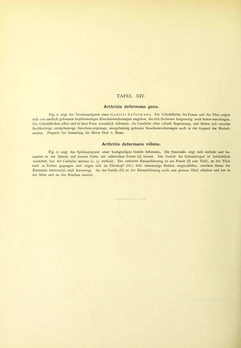 Arthritis deformans genu. Fig. i. zeigt das Trockenpräparat einer Gonitis deformans. Die Gelenkfläche des Femur und der Tibia zeigen sich von rundlich geformten tropfsteinartigen Knochenwucherungen umgeben, die sich theilweise kragenartig nach hinten Umschlagen. Die Gelenkflächen selbst sind in ihrer Form wesentlich deformirt, die Condylen ohne scharfe Begrenzung, und finden sich einzelne flachhöckrige unregelmässige Knochenvorsprünge, unregelmässig geformte Knochenwucherungen auch in der Gegend der Muskel- ansätze. Präparat der Sammlung des Herrn Prof. v. Bruns. Arthritis deformans villosa. Fig. 2. zeigt das Spirituspräparat einer hochgradigen Gonitis deformans. Die Synovialis zeigt sich verdickt und be- sonders in der hintern und äussern Partie mit zahlreichen Zotten (z) besetzt. Die Gestalt der Gelenkkörper ist beträchtlich verändert, bes. der Condylus internus (c. i.) verdickt. Der zerfaserte Knorpelüberzug ist am Femur (f) zum Theil, an der Tibia total zu Verlust gegangen und zeigen sich im Tibiakopf (tib.) tiefe rinnenartige Höhlen eingeschliffen, zwischen denen die Eminentia intercondyl. stark hervorragt. An der Patella (P) ist der Knorpelüberzug noch zum grossen Theil erhalten und nur in der Mitte und an den Rändern zerstört.