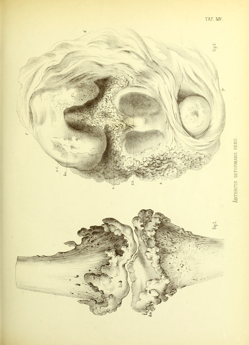 Arthritis deformahs genu.