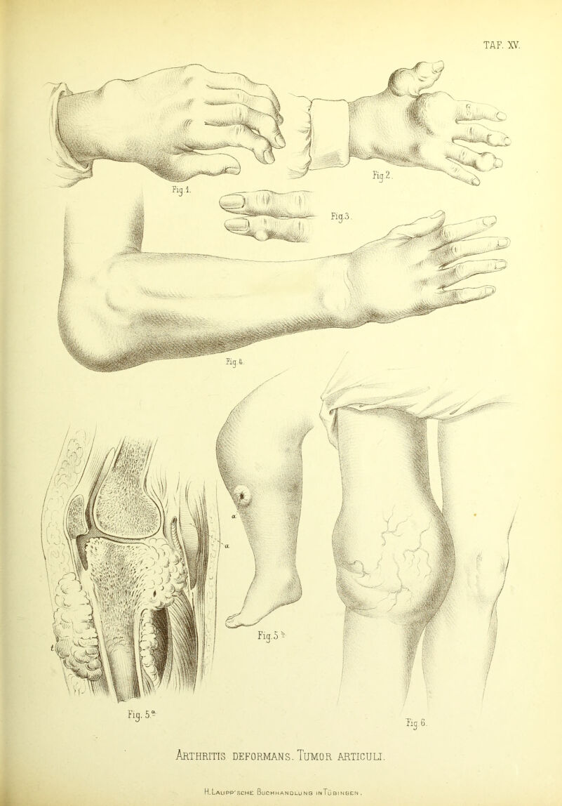 Arthritis deformans. Tumor articult. H.Laupp'sche Buchhandlung inTübingen.