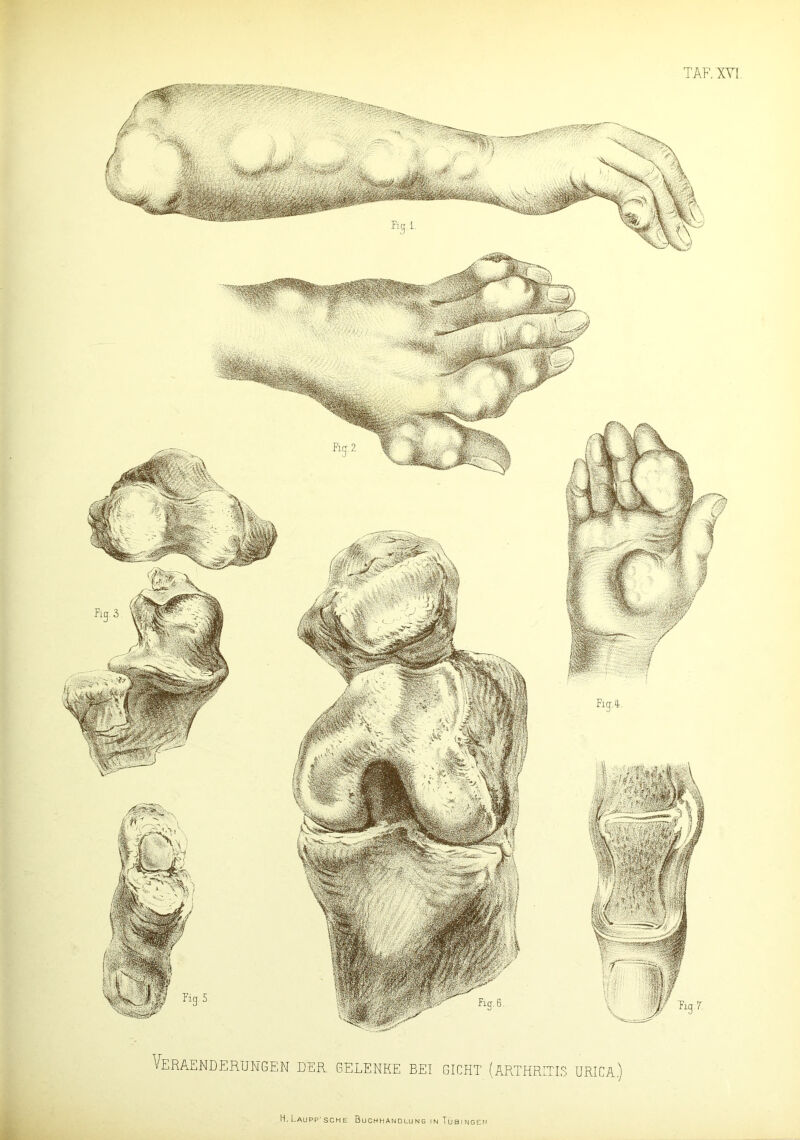 TAF.XVT. Veraenderungen der gelenke bei gicht (Arthritis urica.)