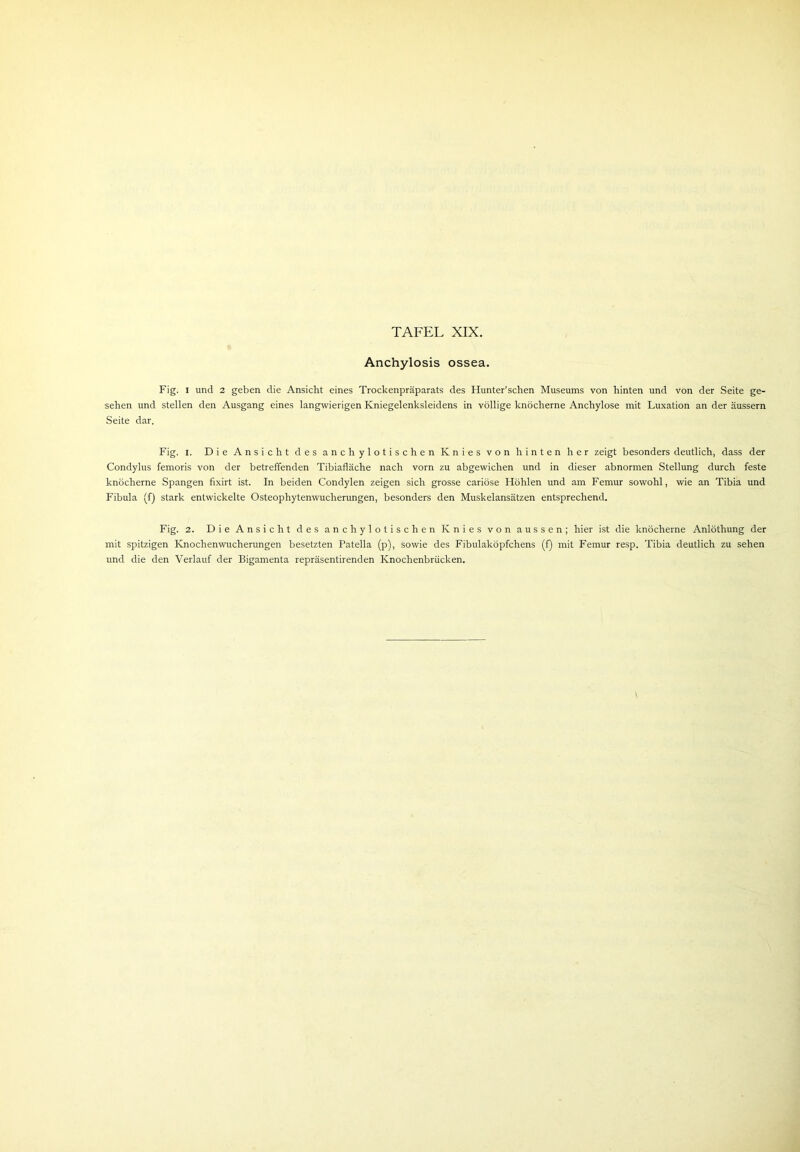 Anchylosis ossea. Fig. I und 2 geben die Ansicht eines Trockenpräparats des Hunter’schen Museums von hinten und von der Seite ge- sehen und stellen den Ausgang eines langwierigen Kniegelenksleidens in völlige knöcherne Anchylose mit Luxation an der äussern Seite dar. Fig. i. Die Ansicht des anchylotischen Knies von hinten her zeigt besonders deutlich, dass der Condylus femoris von der betreffenden Tibiafläche nach vorn zu abgewichen und in dieser abnormen Stellung durch feste knöcherne Spangen fixirt ist. In beiden Condylen zeigen sich grosse cariöse Höhlen und am Femur sowohl, wie an Tibia und Fibula (f) stark entwickelte Osteophytenwucherungen, besonders den Muskelansätzen entsprechend. Fig. 2. Die Ansicht des anchylotischen Knies von aussen; hier ist die knöcherne Anlöthung der mit spitzigen Knochenwucherungen besetzten Patella (p), sowie des Fibulaköpfchens (f) mit Femur resp. Tibia deutlich zu sehen und die den Verlauf der Bigamenta repräsentirenden Knochenbrücken.