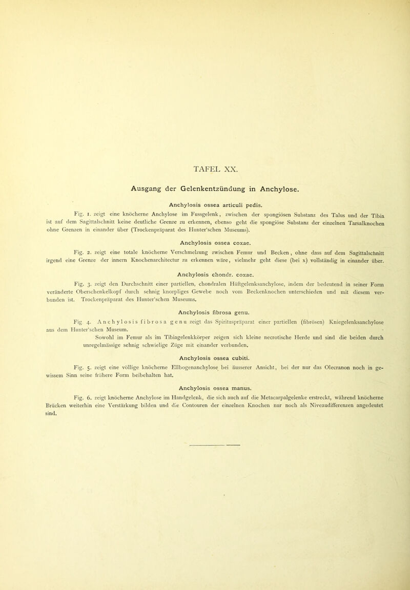 Ausgang der Gelenkentzündung in Anchylose. Anchylosis ossea articuli pedis. Fig. i. zeigt eine knöcherne Anchylose im Fussgelenk, zwischen der spongiösen Substanz des Talus und der Tibia ist auf dem Sagittalschnitt keine deutliche Grenze zu erkennen, ebenso geht die spongiöse Substanz der einzelnen Tarsalknochen ohne Grenzen in einander über (Trockenpräparat des Flunter’schen Museums). Anchylosis ossea coxae. Fig. 2. zeigt eine totale knöcherne Verschmelzung zwischen Femur und Becken, ohne dass auf dem Sagittalschnitt irgend eine Grenze der innern Knochenarchitectur zu erkennen wäre, vielmehr geht diese (bei x) vollständig in einander über. Anchylosis chondr. coxae. Fig. 3. zeigt den Durchschnitt einer partiellen, chondralen Hiiftgelenksanchylose, indem der bedeutend in seiner Form veränderte Oberschenkelkopf durch sehnig knorpliges Gewebe noch vom Beckenknochen unterschieden und mit diesem ver- bunden ist. Trockenpräparat des Flunter’schen Museums. Anchylosis fibrosa genu. Fig, 4. Anchylosis fibrosa genu zeigt das Spirituspräparat einer partiellen (fibrösen) Kniegelenksanchylose aus dem Flunter’schen Museum. Sowohl im Femur als im Tibiagelenkkörper zeigen sich kleine necrotische Flerde und sind die beiden durch unregelmässige sehnig schwielige Züge mit einander verbunden. Anchylosis ossea cubiti. Fig. 5. zeigt eine völlige knöcherne Ellbogenanchylose bei äusserer Ansicht, bei der nur das Olecranon noch in ge- wissem Sinn seine frühere Form beibehalten hat. Anchylosis ossea manus. Fig. 6. zeigt knöcherne Anchylose im Flandgelenk, die sich auch auf die Metacarpalgelenke erstreckt, während knöcherne Brücken weiterhin eine Verstärkung bilden und die Contouren der einzelnen Knochen nur noch als Niveaudifferenzen angedeutet sind.