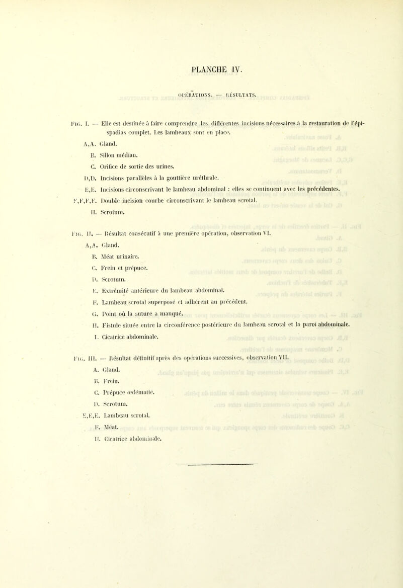 OPÉRATIONS. — RÉSULTATS. Fkj. 1. — Kilo est destinée à faire comprendre les différentes incisions nécessaires à la restauration de l’épi- spadias complet. Les lambeaux sont en place. A,A. Gland. B. Sillon médian. C. Orifice de sortie des urines. i >,D. Incisions parallèles à la gouttière uréthrale. E,E. Incisions circonscrivant le lambeau abdominal : elles se continuent avec les précédentes. E,E,E,E. Double incision courbe circonscrivant le lambeau scrotal. II. Scrotum. Fit;. II. — Késultat consécutif à une première opération, observation VI. A,A. Gland. B. Méat urinaire. C. Frein et prépuce. T). Scrotum. E. Extrémité antérieure du lambeau abdominal. F. Lambeau scrotal superposé et adhérent au précédent. G. Point où la suture a manqué. 11. Fistule située entre la circonférence postérieure du lambeau scrotal et la paroi abdominale. I. Cicatrice abdominale. Eu;, ni. — ltésullat définitif après des opérations successives, observation VIE A. Gland. B. Frein. C. Prépuce œdématié. 1). Scrotum. E,E,E. Lambeau scrotal. F. Méat. II. Cicatrice abdominale.