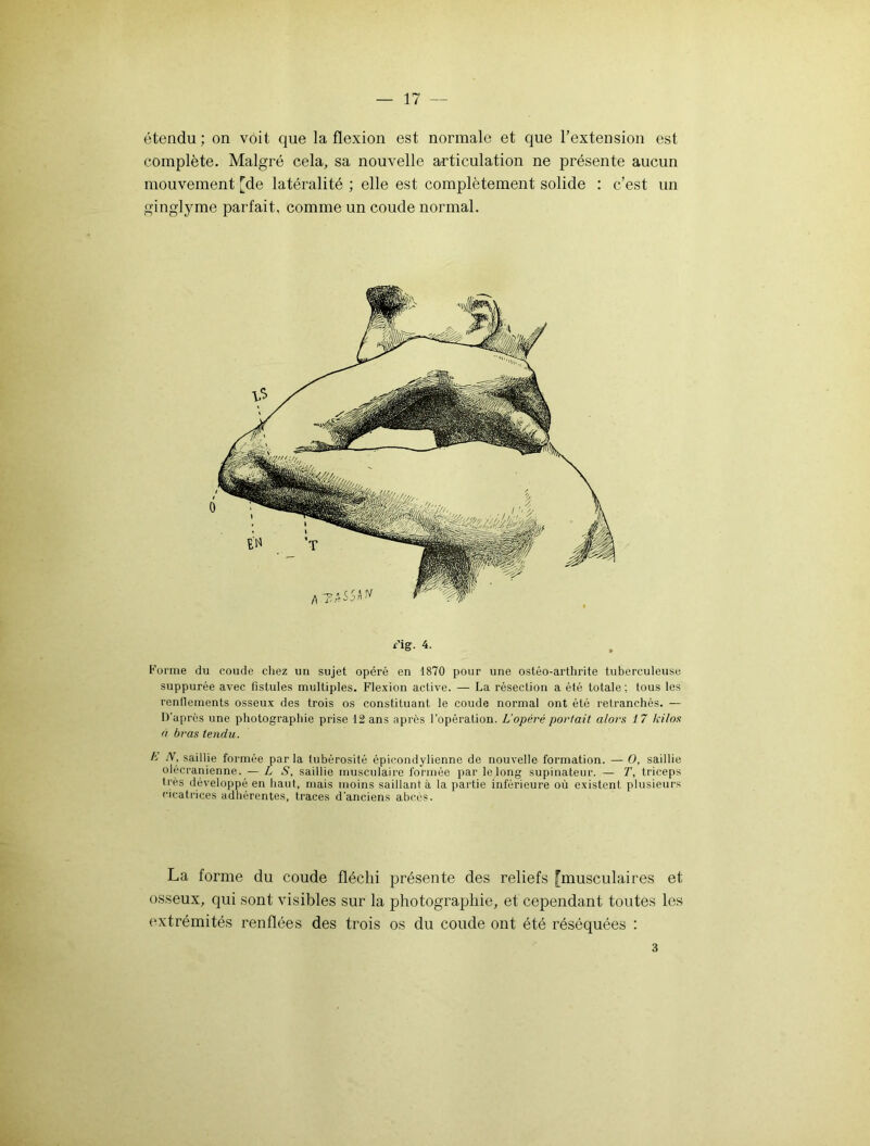 étendu; on voit que la flexion est normale et que l'extension est complète. Malgré cela, sa nouvelle articulation ne présente aucun mouvement [de latéralité ; elle est complètement solide : c’est un ginglyme parfait, comme un coude normal. Fig. 4. Forme du coude chez un sujet opéré en 1870 pour une ostéo-arthrite tuberculeuse suppurée avec fistules multiples. Flexion active. — La résection a été totale ; tous les renflements osseux des trois os constituant le coude normal ont été retranchés. — D’après une photographie prise 12 ans après l’opération. L'opéré portait alors 17 kilos à bras tendu. K N, saillie formée parla tubérosité épicondylienne de nouvelle formation. — O, saillie olécranienne. — LS, saillie musculaire formée par le long supinateur. — T, triceps très développé en haut, mais moins saillant à la partie inférieure où existent plusieurs cicatrices adhérentes, traces d’anciens abcès. La forme du coude fléchi présente des reliefs [musculaires et osseux, qui sont visibles sur la photographie, et cependant toutes les extrémités renflées des trois os du coude ont été réséquées : 3