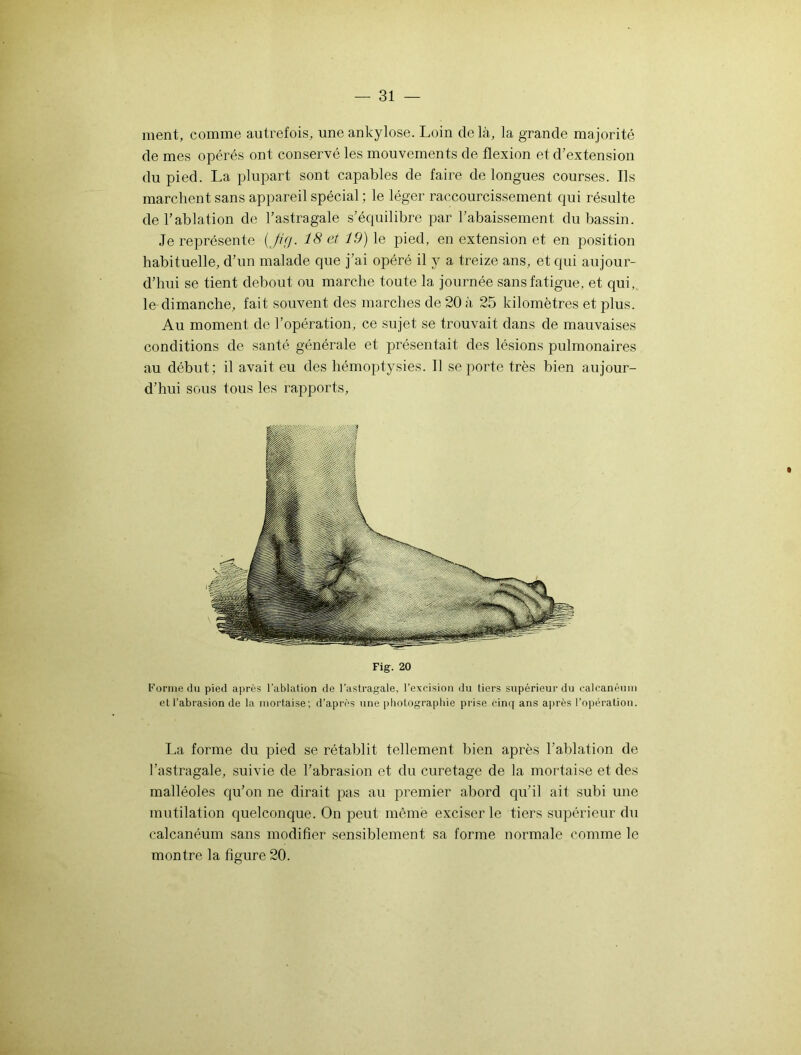 ment, comme autrefois, une ankylosé. Loin delà, la grande majorité de mes opérés ont conservé les mouvements de flexion et d’extension du pied. La plupart sont capables de faire de longues courses. Ils marchent sans appareil spécial ; le léger raccourcissement qui résulte de l’ablation de l’astragale s’équilibre par l’abaissement du bassin. Je représente (Jig. 18 et 19) le pied, en extension et en position habituelle, d’un malade que j’ai opéré il y a treize ans, et qui aujour- d’hui se tient debout ou marche toute la journée sans fatigue, et qui, le dimanche, fait souvent des marches de 20 à 25 kilomètres et plus. Au moment de l’opération, ce sujet se trouvait dans de mauvaises conditions de santé générale et présentait des lésions pulmonaires au début; il avait eu des hémoptysies. Il se porte très bien aujour- d’hui sous tous les rapports, Fig. 20 Forme du pied après l’ablation de l’astragale, l’excision du tiers supérieur du calcanéum et l’abrasion de la mortaise; d’après une photographie prise cinq ans après l’opération. La forme du pied se rétablit tellement bien après l’ablation de l’astragale, suivie de l’abrasion et du curetage de la mortaise et des malléoles qu’on ne dirait pas au premier abord qu’il ait subi une mutilation quelconque. On peut même exciser le tiers supérieur du calcanéum sans modifier sensiblement sa forme normale comme le montre la figure 20.