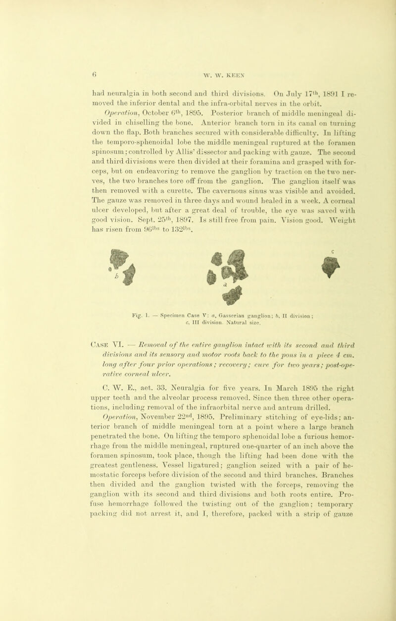 liad neuralgia in both second and third divisions. On July 17th, 181(1 I re- moved the inferior dental and the infra-orbital nerves in the orbit. Operation, October 6th, 1895. Posterior branch of middle meningeal di- vided in chiselling the bone. Anterior branch torn in its canal on turning down the flaj). Both branches secured with considerable difficulty. In lifting the temporo-sphenoidal lobe the middle meningeal ruptured at the foramen spinosum; controlled by Allis’ dissector and packing with gauze. The second and third divisions were then divided at their foramina and grasped with for- ceps, but on endeavoring to remove the ganglion by traction on the two ner- ves, the two branches tore off from the ganglion. The ganglion itself was then removed with a curette. The cavernous sinus was visible and avoided. The gauze was removed in three days and wound healed in a week. A corneal ulcer developed, but after a great deal of trouble, the eye was saved with good vision. Sept. 25th, 1897. Is still free from pain. Vision good. Weight has risen from 9G1,)S to 132lljs. A Fig. 1. — Specimen Case V: a, Gasserian ganglion; b. II division; c, III division. Natural size. CASE VI. — Removal of the entire ganglion intact with its second and third divisions and its sensory and motor roots hack to the pons in a piece 4 cm. long after four prior operations; recovery; cure for two years; post-ope- rative corneal ulcer. C. W. E., aet. 33. Neuralgia for five years. In March 1895 the right upper teeth and the alveolar process removed. Since then three other opera- tions, including removal of the infraorbital nerve and antrum drilled. Operation, November 22,ul, 1895. Preliminary stitching of eye-lids; an- terior branch of middle meningeal torn at a point where a large branch penetrated the bone. On lifting the temporo sphenoidal lobe a furious hemor- rhage from the middle meningeal, ruptured one-quarter of an inch above the foramen spinosum, took place, though the lifting had been done with the greatest gentleness. Vessel ligatured; ganglion seized with a pair of he- mostatic forceps before division of the second and third branches. Branches then divided and the ganglion twisted with the forceps, removing the ganglion with its second and third divisions and both roots entire. Pro- fuse hemorrhage followed the twisting out of the ganglion: temporary packing did not arrest it, and I, therefore, packed with a strip of gauze