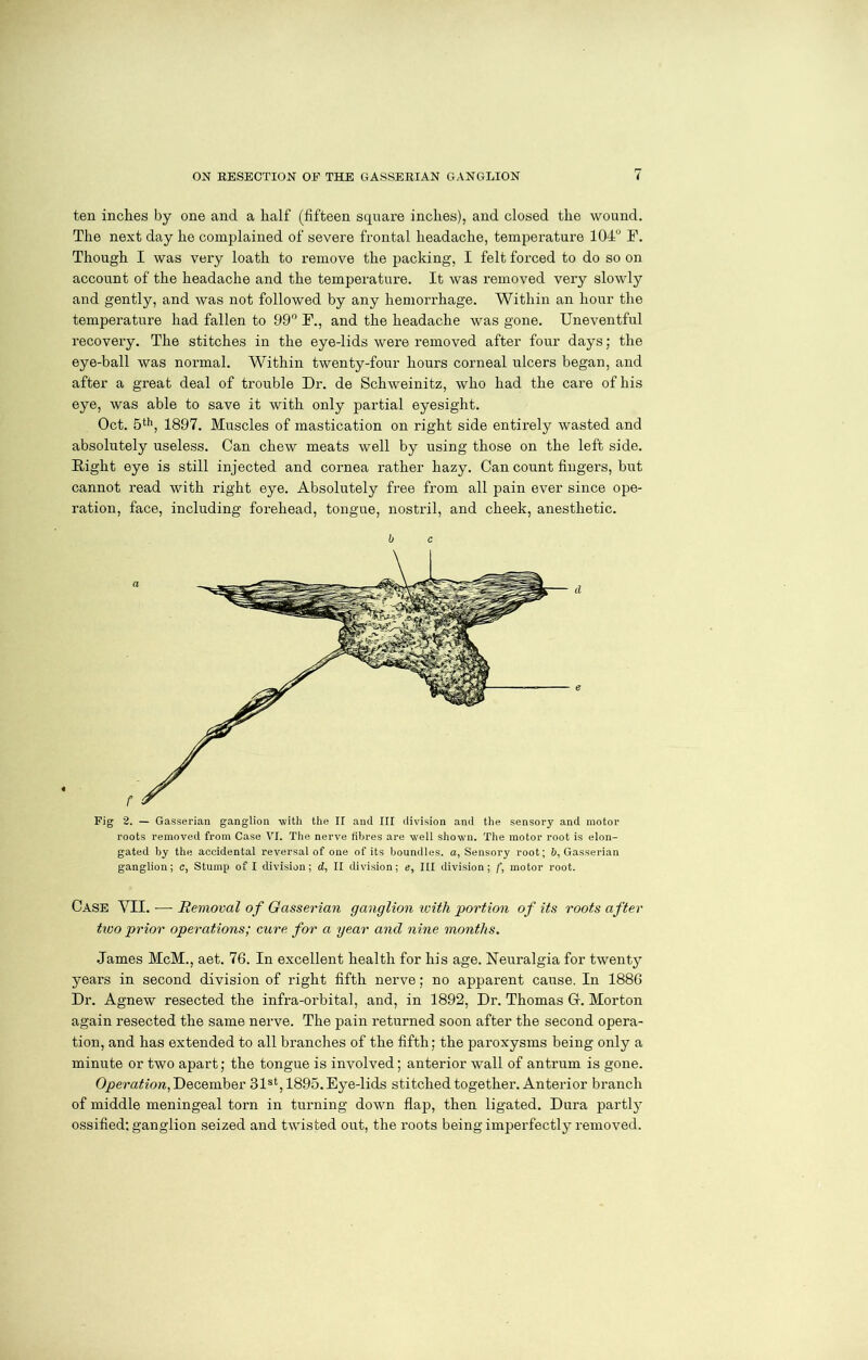 ten inches by one and a half (fifteen square inches), and closed the wound. The next day he complained of severe frontal headache, temperature 104° F. Though I was very loath to remove the packing, I felt forced to do so on account of the headache and the temperature. It was removed very slowly and gently, and was not followed by any hemorrhage. Within an hour the temperature had fallen to 99° F., and the headache was gone. Uneventful recovery. The stitches in the eye-lids were removed after four days; the eye-ball was normal. Within twenty-four hours corneal ulcers began, and after a great deal of trouble Dr. de Schweinitz, who had the care of his eye, was able to save it with only partial eyesight. Oct. 5th, 1897. Muscles of mastication on right side entirely wasted and absolutely useless. Can chew meats well by using those on the left side. Right eye is still injected and cornea rather hazy. Can count fingers, but cannot read with right eye. Absolutely free from all pain ever since ope- ration, face, including forehead, tongue, nostril, and cheek, anesthetic. b c Fig 2. — Gasserian ganglion with the II and III division and the sensory and motor roots removed from Case VI. The nerve fibres are well shown. The motor root is elon- gated by the accidental reversal of one of its boundles. a, Sensory root; 6, Gasserian ganglion; c, Stump of I division; d, II division; e, III division; f, motor root. Case YII. ■— Removal of Gasserian ganglion with portion of its roots after two prior operations; cure for a year and nine months. James McM., aet. 76. In excellent health for his age. Neuralgia for twenty years in second division of right fifth nerve; no apparent cause. In 1886 Dr. Agnew resected the infra-orbital, and, in 1892, Dr. Thomas Cr. Morton again resected the same nerve. The pain returned soon after the second opera- tion, and has extended to all branches of the fifth; the paroxysms being only a minute or two apart; the tongue is involved; anterior wall of antrum is gone. Operation, December 31st, 1895. Eye-lids stitched together. Anterior branch of middle meningeal torn in turning down flap, then ligated. Dura partly ossified; ganglion seized and twisted out, the roots being imperfectly removed.