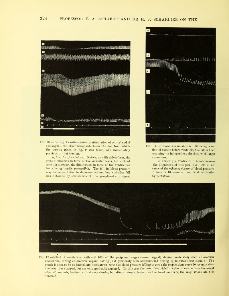 Fig. 10.—Testing of cardiac centre by stimulation of central end of one vagus—the other being intact—in the dog from which the tracing given in fig. 9 was taken, and immediately previous to that tracing. a, b, c, d, e, / as before. Notice, as with chloroform, the great diminution in force of the auricular beats, but without arrest or slowing, the diminution in force of the ventricular beats being hardly perceptible. The fall in blood-pressure may be in part due to depressor action, but a similar fall was obtained by stimulation of the peripheral cut vagus. Fig. 11.—Chloroform inhalation. Showing cessa- tion of auricle before ventricle, the latter then assuming its independent rhythm, with larger excursions. a, auricle ; b, ventricle; c, blood-pressure (the alignment of this pen is a little in ad- vance of the others); c1, zero of blood-pressure ; d, time in 10 seconds. Artificial respiration by perflation. Fig. 12.—Effect of excitation (with coil 100) of the peripheral vagus (second signal) during moderately deep chloroform anaesthesia, strong chloroform vapour having just previously been administered during 1^ minutes (first signal). The result is seen to be an immediate heart arrest, with the blood-pressure falling to zero ; the respirations cease 30 seconds after the heart has stopped, but are only gradually arrested. In this case the heart (ventricle ?) begins to escape from the arrest after 40 seconds, beating at first very slowly, but after a minute faster: as the heart recovers, the respirations are also renewed.