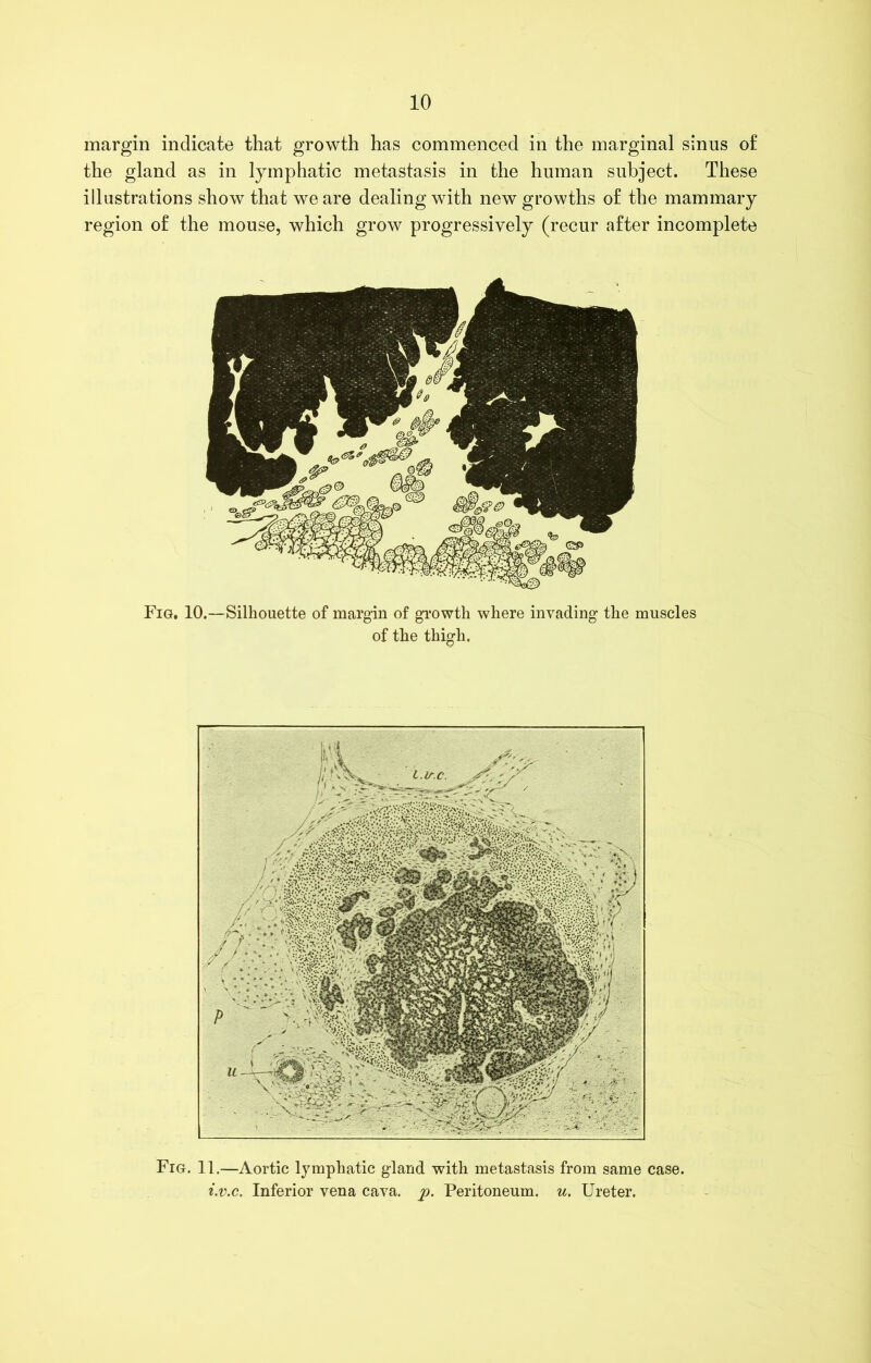margin indicate that growth has commenced in the marginal sinus of the gland as in lymphatic metastasis in the human subject. These illustrations show that we are dealing with new growths of the mammary region of the mouse, which grow progressively (recur after incomplete Fig. 10.—Silhouette of margin of growth where invading the muscles of the thigh. Fig. 11.—Aortic lymphatic gland with metastasis from same case. i.v.c. Inferior vena cava. p. Peritoneum, u. Ureter.