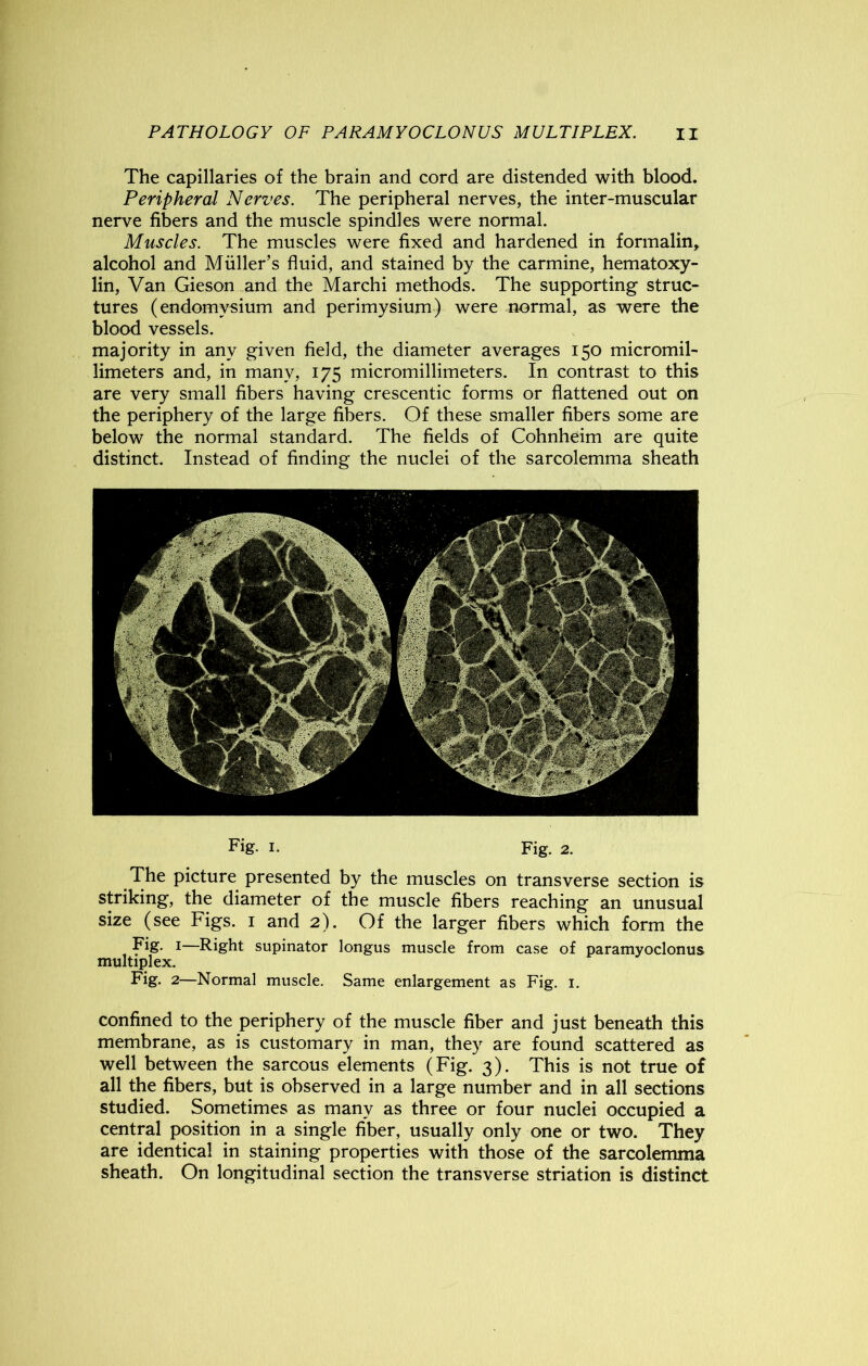 The capillaries of the brain and cord are distended with blood. Peripheral Nerves. The peripheral nerves, the inter-muscular nerve fibers and the muscle spindles were normal. Muscles. The muscles were fixed and hardened in formalin, alcohol and Muller’s fluid, and stained by the carmine, hematoxy- lin, Van Gieson and the Marchi methods. The supporting struc- tures (endomvsium and perimysium) were normal, as were the blood vessels. majority in any given field, the diameter averages 150 micromil- limeters and, in many, 175 micromillimeters. In contrast to this are very small fibers having crescentic forms or flattened out on the periphery of the large fibers. Of these smaller fibers some are below the normal standard. The fields of Cohnheim are quite distinct. Instead of finding the nuclei of the sarcolemma sheath Fig. 1. Fig. 2. The picture presented by the muscles on transverse section is striking, the diameter of the muscle fibers reaching an unusual size (see Figs. 1 and 2). Of the larger fibers which form the Fig. 1—Right supinator longus muscle from case of paramyoclonus multiplex. Fig. 2—Normal muscle. Same enlargement as Fig. 1. confined to the periphery of the muscle fiber and just beneath this membrane, as is customary in man, they are found scattered as well between the sarcous elements (Fig. 3). This is not true of all the fibers, but is observed in a large number and in all sections studied. Sometimes as many as three or four nuclei occupied a central position in a single fiber, usually only one or two. They are identical in staining properties with those of the sarcolemma sheath. On longitudinal section the transverse striation is distinct