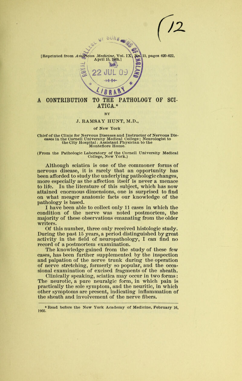 ATICA* BY J. RAMSAY HUNT, M.D., of New York Chief of the Clinic for Nervous Diseases and Instructor of Nervous Dis- eases in the Cornell University Medical College; Neurologist to the City Hospital; Assistant Physician to the Montefiore Home. (From the Pathologic Laboratory of the Cornell University Medical College, New York.) Although sciatica is one of the commoner forms of nervous disease, it is rarely that an opportunity has been afforded to study the underlying pathologic changes, more especially as the affection itself is never a menace to life. In the literature of this subject, which has now attained enormous dimensions, one is surprised to find on what meager anatomic facts our knowledge of the pathology is based. I have been able to collect only 11 cases in which the condition of the nerve was noted postmortem, the majority of these observations emanating from the older writers. Of this number, three only received histologic study. During the past 15 years, a period distinguished by great activity in the field of neuropathology, I can find no record of a postmortem examination. The knowledge gained from the study of these few cases, has been further supplemented by the inspection and palpation of the nerve trunk during the operation of nerve stretching, formerly so popular, and the occa- sional examination of excised fragments of the sheath. Clinically speaking, sciatica may occur in two forms: The neurotic, a pure neuralgic form, in which pain is practically the sole symptom, and the neuritic, in which other symptoms are present, indicating inflammation of the sheath and involvement of the nerve fibers. *Read before the New York Academy of Medicine, February 16, 1906.