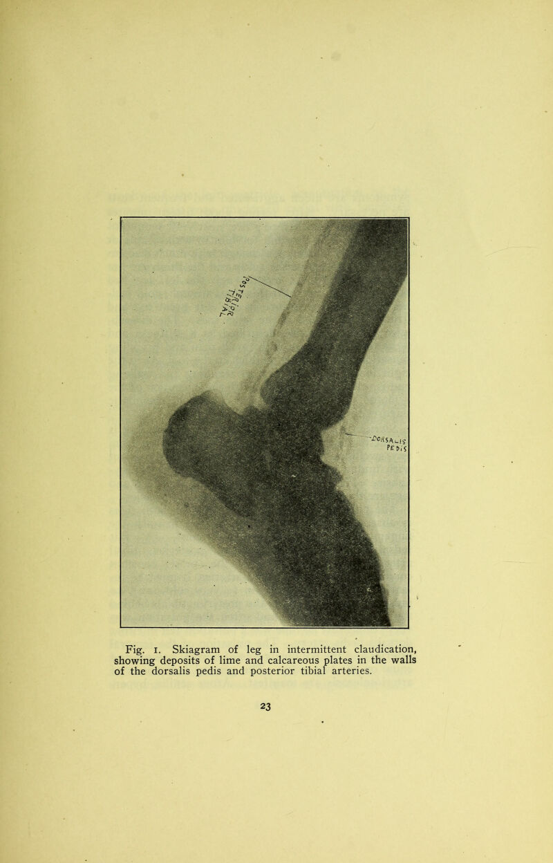 Fig. I. Skiagram of leg in intermittent claudication, showing deposits of lime and calcareous plates in the walls of the dorsalis pedis and posterior tibial arteries.