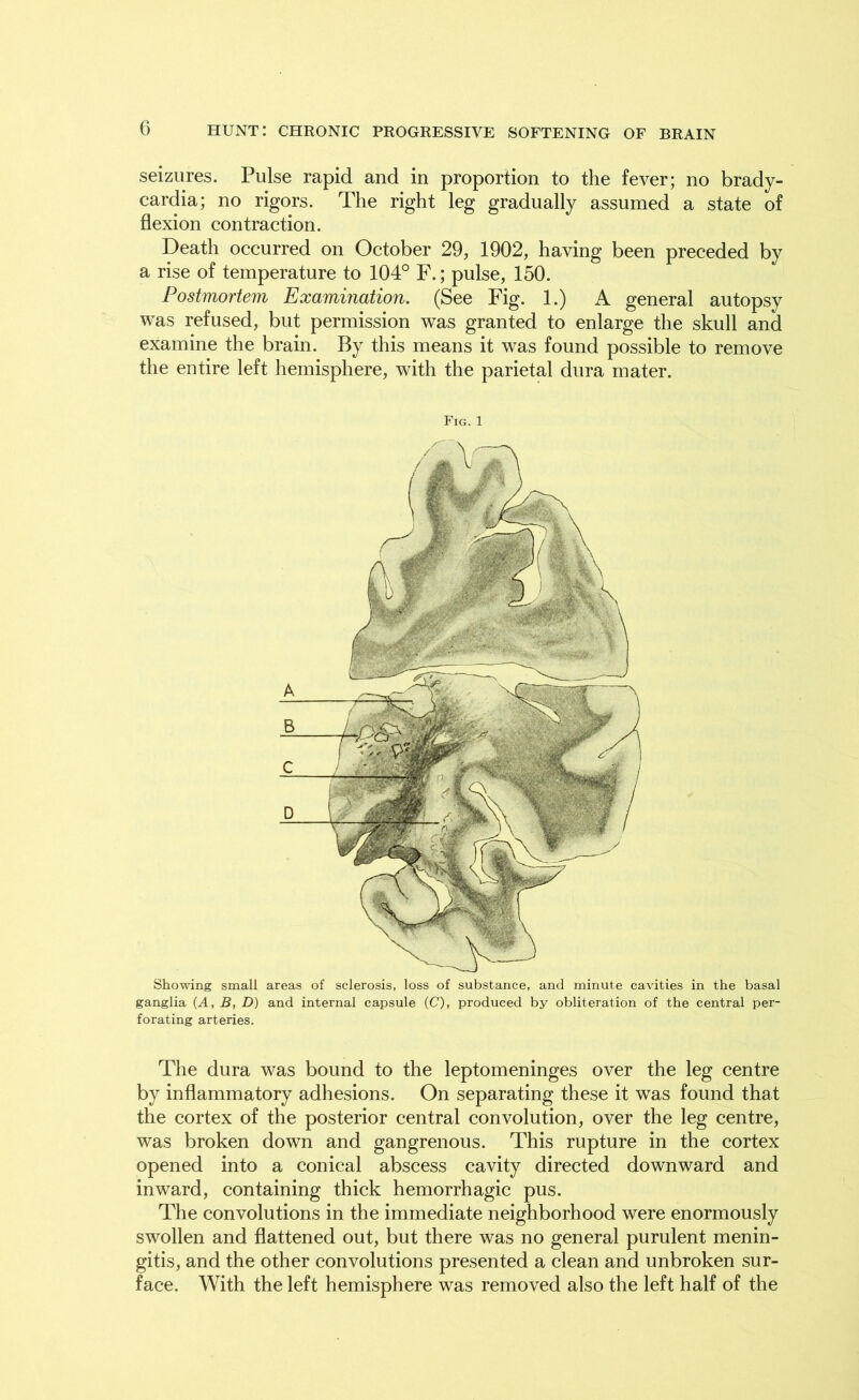 seizures. Pulse rapid and in proportion to the fever; no brady- cardia; no rigors. The right leg gradually assumed a state of flexion contraction. Death occurred on October 29, 1902, having been preceded by a rise of temperature to 104° F.; pulse, 150. Postmortem Examination. (See Fig. 1.) A general autopsy was refused, but permission was granted to enlarge the skull and examine the brain. By this means it was found possible to remove the entire left hemisphere, with the parietal dura mater. Fig. 1 Showing small areas of sclerosis, loss of substance, and minute cavities in the basal ganglia (A, B, D) and internal capsule (C), produced by obliteration of the central per- forating arteries. The dura was bound to the leptomeninges over the leg centre by inflammatory adhesions. On separating these it was found that the cortex of the posterior central convolution, over the leg centre, was broken down and gangrenous. This rupture in the cortex opened into a conical abscess cavity directed downward and inward, containing thick hemorrhagic pus. The convolutions in the immediate neighborhood were enormously swollen and flattened out, but there was no general purulent menin- gitis, and the other convolutions presented a clean and unbroken sur- face. With the left hemisphere was removed also the left half of the