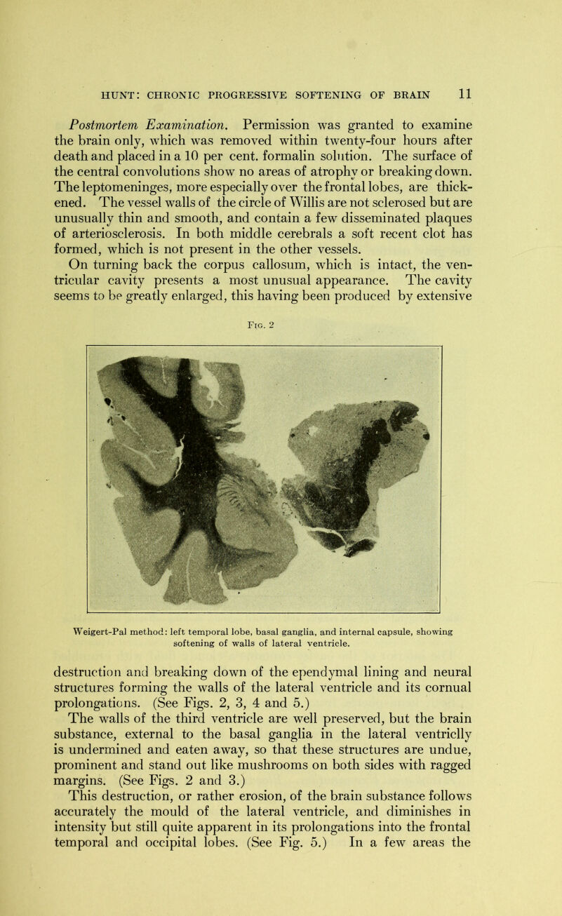 Postmortem Examination. Permission was granted to examine the brain only, which was removed within twenty-four hours after death and placed in a 10 per cent, formalin solution. The surface of the central convolutions show no areas of atrophy or breaking down. The leptomeninges, more especially over the frontal lobes, are thick- ened. The vessel walls of the circle of Willis are not sclerosed but are unusually thin and smooth, and contain a few disseminated plaques of arteriosclerosis. In both middle cerebrals a soft recent clot has formed, which is not present in the other vessels. On turning back the corpus callosum, which is intact, the ven- tricular cavity presents a most unusual appearance. The cavity seems to be greatly enlarged, this having been produced by extensive Fig. 2 Weigert-Pal method: left temporal lobe, basal ganglia, and internal capsule, showing softening of walls of lateral ventricle. destruction and breaking down of the ependymal lining and neural structures forming the walls of the lateral ventricle and its cornual prolongations. (See Figs. 2, 3, 4 and 5.) The walls of the third ventricle are well preserved, but the brain substance, external to the basal ganglia in the lateral ventriclly is undermined and eaten away, so that these structures are undue, prominent and stand out like mushrooms on both sides with ragged margins. (See Figs. 2 and 3.) This destruction, or rather erosion, of the brain substance follows accurately the mould of the lateral ventricle, and diminishes in intensity but still quite apparent in its prolongations into the frontal temporal and occipital lobes. (See Fig. 5.) In a few areas the