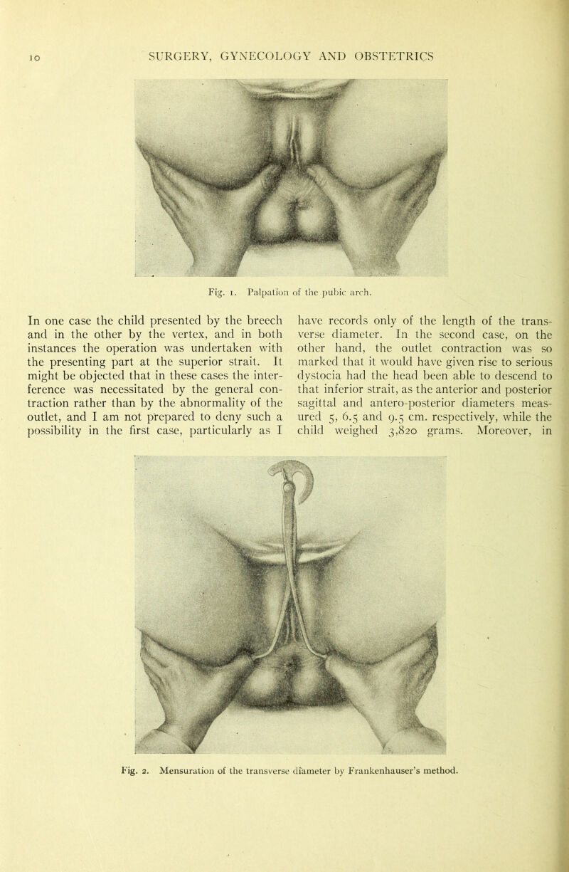 Fig. i. Palpation of the pubic arch. In one case the child presented by the breech and in the other by the vertex, and in both instances the operation was undertaken with the presenting part at the superior strait. It might be objected that in these cases the inter- ference was necessitated by the general con- traction rather than by the abnormality of the outlet, and I am not prepared to deny such a possibility in the first case, particularly as I have records only of the length of the trans- verse diameter. In the second case, on the other hand, the outlet contraction was so marked that it would have given rise to serious dystocia had the head been able to descend to that inferior strait, as the anterior and posterior sagittal and antero-posterior diameters meas- ured 5, 6.5 and 9.5 cm. respectively, while the child weighed 3,820 grams. Moreover, in Fig. 2. Mensuration of the transverse diameter by Frankenhauser’s method.