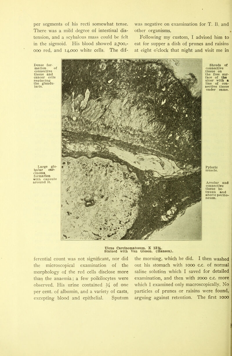 per segments of his recti somewhat tense. There was a mild degree of intestinal dis- tension, and a scybalous mass could be felt in the sigmoid. His blood showed 2,700,- 000 red, and 14,000 white cells. The dif- was negative on examination for T. B. and other organisms. Following my custom, I advised him to eat for supper a dish of prunes and raisins at eight o’clock that night and visit me in Dense for- mation of connective tissue and cancer cells replacing the glandu- laris. Large glo- bular car- cinoma formation with capsule around it. Shreds of connective tissue on the free sur- face of the ulcer with a line of con- nective tissue under same. Pyloric muscle. Areolar and connective tissue be- tween and above perito- neum. Ulcus Carcinomatosum. X 13%. Stained with Van Gieson. (Hanson). ferential count was not significant, nor did the microscopical examination of the morphology of the red cells disclose more than the anaemia; a few poikilocytes were observed. His urine contained ^ of one per cent, of albumin, and a variety of casts, excepting blood and epithelial. Sputum the morning, which he did. I then washed out his stomach with 1000 c.c. of normal saline solution which I saved for detailed examination, and then with 2000 c.c. more which I examined only macroscopically. No particles of prunes or raisins were found, arguing against retention. The first 1000