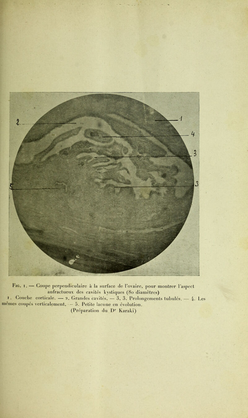 Fig. i. — Coupe perpendiculaire à la surface de l’ovaire, pour montrer l’aspect anfractueux des cavités kystiques (80 diamètres) i. Couche corticale. — 2. Grandes cavités. — 3. 3. Prolongements tubulés. — l\. Les memes coupés verticalement. — 5. Petite lacune en évolution.