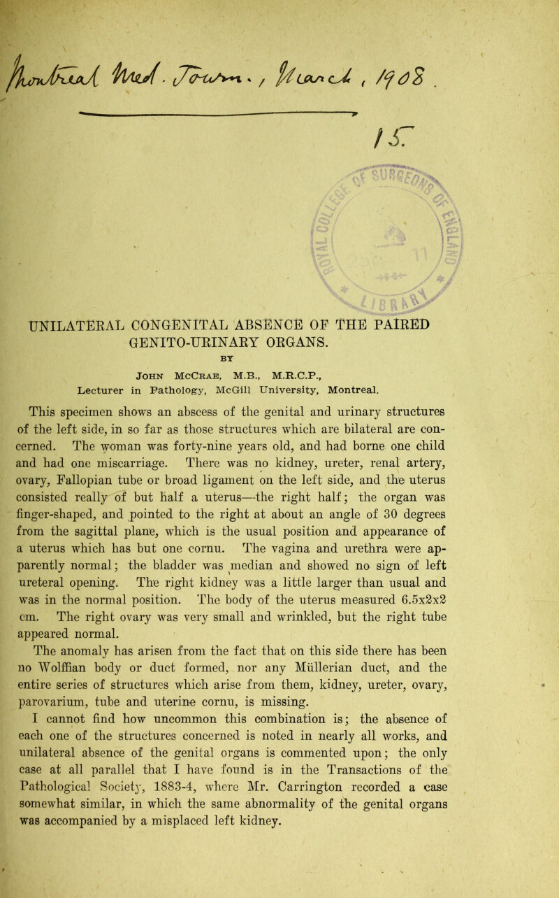 'pfyitd■ »* / f/iWc/ , dS !S7 UNILATERAL CONGENITAL ABSENCE OP THE PAIRED GENITO-URINARY ORGANS. BY John McCrae, M.B., M.R.C.P., Lecturer in Pathology, McGill University, Montreal. This specimen shows an abscess of the genital and urinary structures of the left side, in so far as those structures which are bilateral are con- cerned. The woman was forty-nine years old, and had borne one child and had one miscarriage. There was no kidney, ureter, renal artery, ovary, Fallopian tube or broad ligament on the left side, and the uterus consisted really^of but half a uterus—the right half; the organ was finger-shaped, and pointed to the right at about an angle of 30 degrees from the sagittal plane, which is the usual position and appearance of a uterus which has but one cornu. The vagina and urethra were ap- parently normal; the bladder was median and showed no sign of left ureteral opening. The right kidney was a little larger than usual and was in the normal position. The body of the uterus measured 6.5x2x2 cm. The right ovary was very small and wrinkled, but the right tube appeared normal. The anomaly has arisen from the fact that on this side there has been no Wolffian body or duct formed, nor any Mullerian duct, and the entire series of structures which arise from them, kidney, ureter, ovary, parovarium, tube and uterine cornu, is missing. I cannot find how uncommon this combination is; the absence of each one of the structures concerned is noted in nearly all works, and unilateral absence of the genital organs is commented upon; the only case at all parallel that I have found is in the Transactions of the Pathological Societ}', 1883-4, where Mr. Carrington recorded a case somewhat similar, in which the same abnormality of the genital organs was accompanied by a misplaced left kidney.