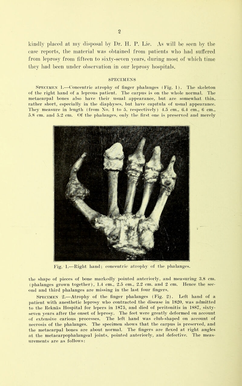 kindly placed at my disposal by Dr. H. P. Lie. As will be seen by the case reports, the material was obtained from patients who had suffered from leprosy from fifteen to sixty-seven years, during most of which time they had been under observation in our leprosy hospitals. SPECIMENS the shape of pieces of hone markedly pointed anteriorly, and measuring 3.8 cm. (phalanges grown together), 1.4 cm., 2.5 cm., 2.2 cm. and 2 cm. Hence the sec- ond and third phalanges are missing in the last four fingers. Specimen 2.—Atrophy of the finger phalanges (Fig. 2). Left hand of a patient with anesthetic leprosy who contracted the disease in 1820, was admitted to the Reknas Hospital for lepers in 1875, and died of peritonitis' in 1887, sixty- seven years after the onset of leprosy. The feet were greatly deformed on account of extensive carious processes. The left hand was club-shaped on account of necrosis of the phalanges. The specimen shows that the carpus is preserved, and the metacarpal bones are about normal. The fingers are flexed at right angles at the metacarpophalangeal joints, pointed anteriorly, and defective. The meas- urements' are as follows: Specimen 1.—Concentric atrophy of finger phalanges (Fig. 1). The skeleton of the right hand of a leprous patient. The carpus is on the whole normal. The metacarpal bones also have their usual appearance, but are somewhat thin, rather short, especially in the diaphyses, but have capitula of usual appearance. They measure in length (from No. 1 to 5, respectively) 4.5 cm., 6.4 cm., 6 cm., 5.8 cm. and 5.2 cm. Of the phalanges, only the first one is preserved and merely Fig. 1.—Right hand; concentric atrophy of the phalanges.