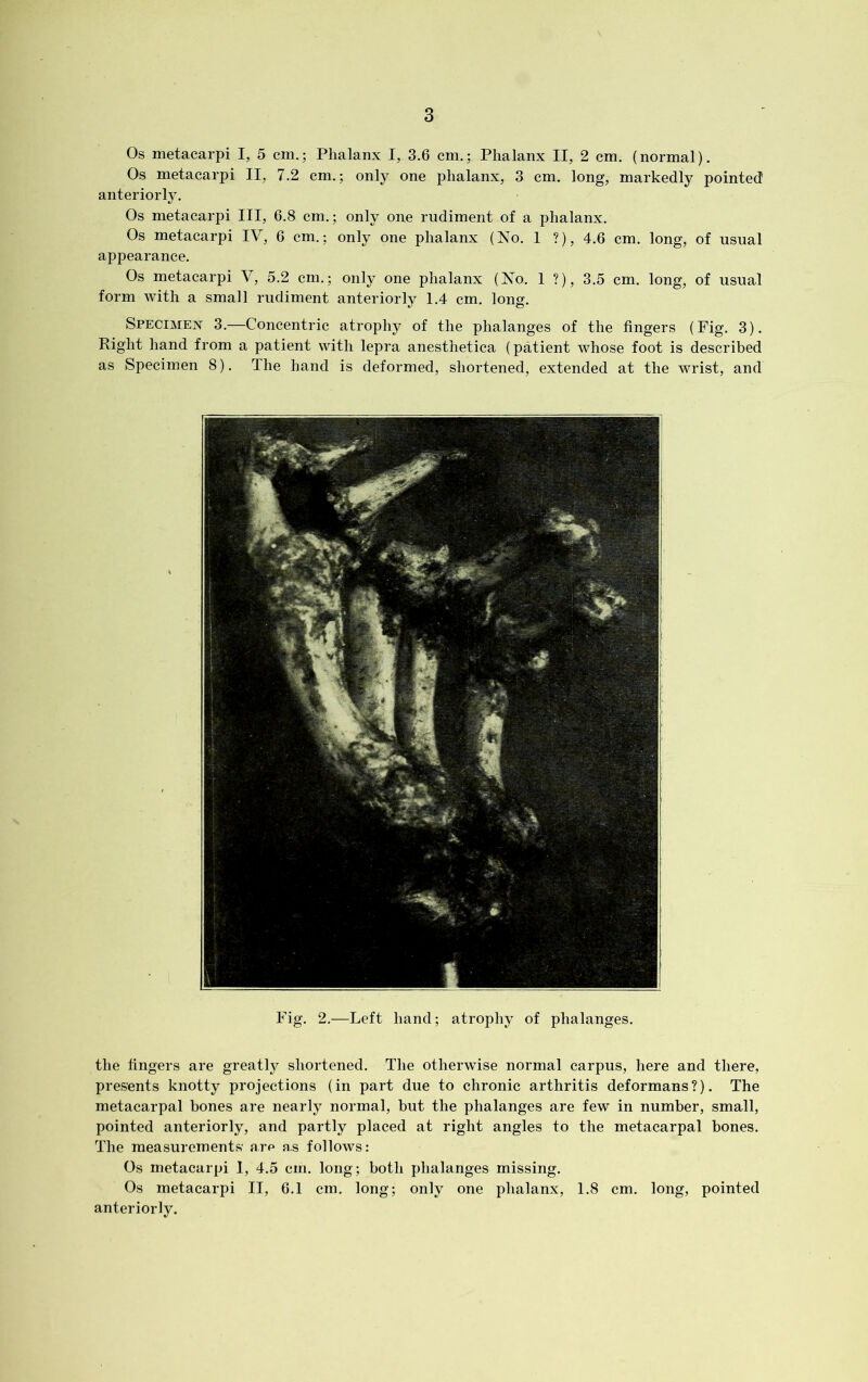 Os metacarpi I, 5 cm.; Phalanx I, 3.6 cm.; Phalanx II, 2 cm. (normal). Os metacarpi II, 7.2 cm.; only one phalanx, 3 cm. long, markedly pointed anteriorly. Os metacarpi III, 6.8 cm.; only one rudiment of a phalanx. Os metacarpi IV, 6 cm.; only one phalanx (No. 1 ?), 4.6 cm. long, of usual appearance. Os metacarpi V, 5.2 cm.; only one phalanx (No. 1 ?), 3.5 cm. long, of usual form with a small rudiment anteriorly 1.4 cm. long. Specimen 3.—Concentric atrophy of the phalanges of the fingers (Fig. 3). Right hand from a patient with lepra anesthetica (patient whose foot is described as Specimen 8). The hand is deformed, shortened, extended at the wrist, and Fig. 2.—Left hand; atrophy of phalanges. the fingers are greatly shortened. The otherwise normal carpus, here and there, presents knotty projections (in part due to chronic arthritis deformans?). The metacarpal bones are nearly normal, but the phalanges are few in number, small, pointed anteriorly, and partly placed at right angles to the metacarpal bones. The measurements' arp as follows: Os metacarpi 1, 4.5 cm. long; both phalanges missing. Os metacarpi II, 6.1 cm. long; only one phalanx, 1.8 cm. long, pointed anteriorly.