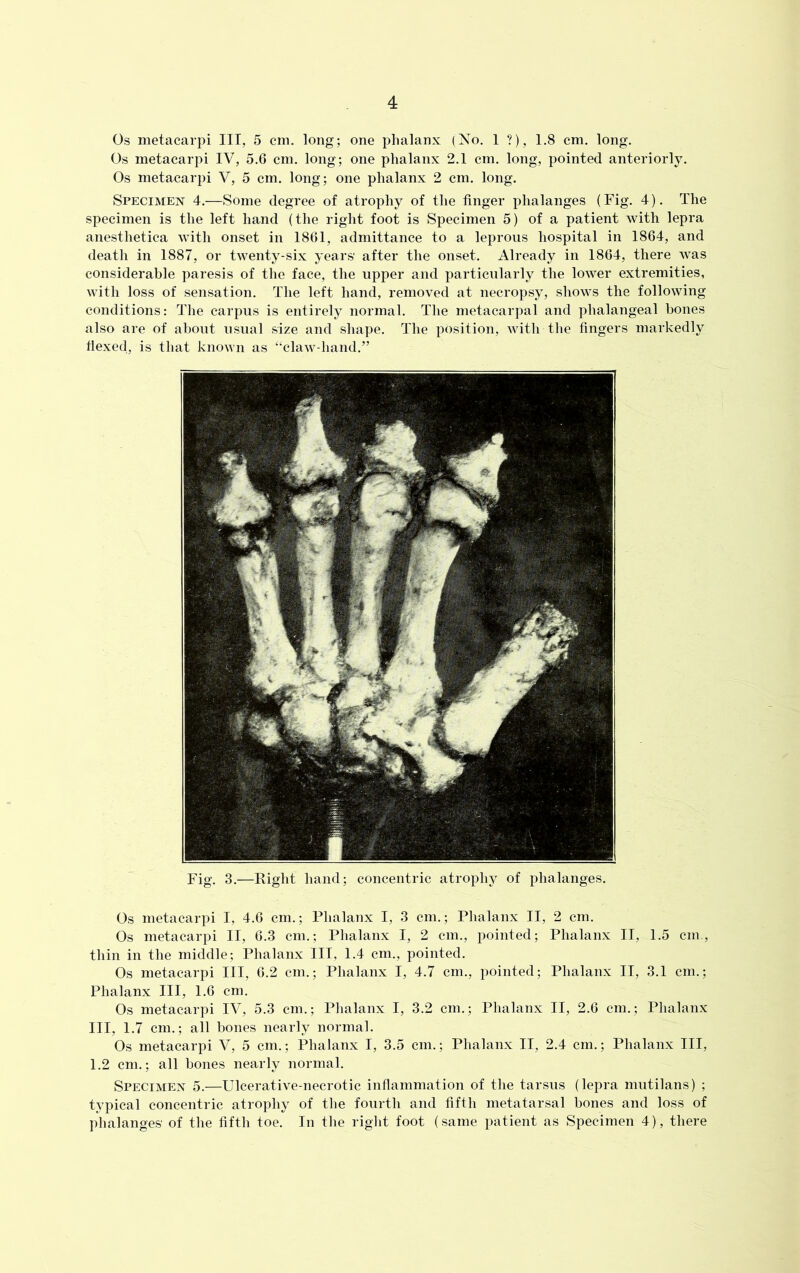 Os metacarpi III, 5 cm. long; one phalanx (No. 1 ?), 1.8 cm. long. Os metacarpi IV, 5.6 cm. long; one phalanx 2.1 cm. long, pointed anteriorly. Os metacarpi V, 5 cm. long; one phalanx 2 cm. long. Specimen 4.—Some degree of atrophy of the finger phalanges (Fig. 4). The specimen is the left hand (the right foot is Specimen 5) of a patient with lepra anesthetica with onset in 1861, admittance to a leprous hospital in 1864, and death in 1887, or twenty-six years' after the onset. Already in 1864, there was considerable paresis of the face, the upper and particularly the lower extremities, with loss of sensation. The left hand, removed at necropsy, shows the following conditions: The carpus is entirely normal. The metacarpal and phalangeal bones also are of about usual size and shape. The position, with the fingers markedly flexed, is that known as “claw-hand.” Fig. 3.—Right hand; concentric atrophy of phalanges. Os metacarpi I, 4.6 cm.; Phalanx I, 3 cm.; Phalanx II, 2 cm. Os metacarpi II, 6.3 cm.; Phalanx I, 2 cm., pointed; Phalanx II, 1.5 cm., thin in the middle; Phalanx III, 1.4 cm., pointed. Os metacarpi III, 6.2 cm.; Phalanx I, 4.7 cm., pointed; Phalanx II, 3.1 cm.; Phalanx III, 1.6 cm. Os metacarpi IV, 5.3 cm.; Phalanx I, 3.2 cm.; Phalanx II, 2.6 cm.; Phalanx III, 1.7 cm.; all bones nearly normal. Os metacarpi V, 5 cm.; Phalanx I, 3.5 cm.; Phalanx II, 2.4 cm.; Phalanx III, 1.2 cm.; all bones nearly normal. Specimen 5.—Ulcerative-necrotic inflammation of the tarsus (lepra mutilans) ; typical concentric atrophy of the fourth and fifth metatarsal bones and loss of phalanges' of the fifth toe. In the right foot (same patient as Specimen 4), there