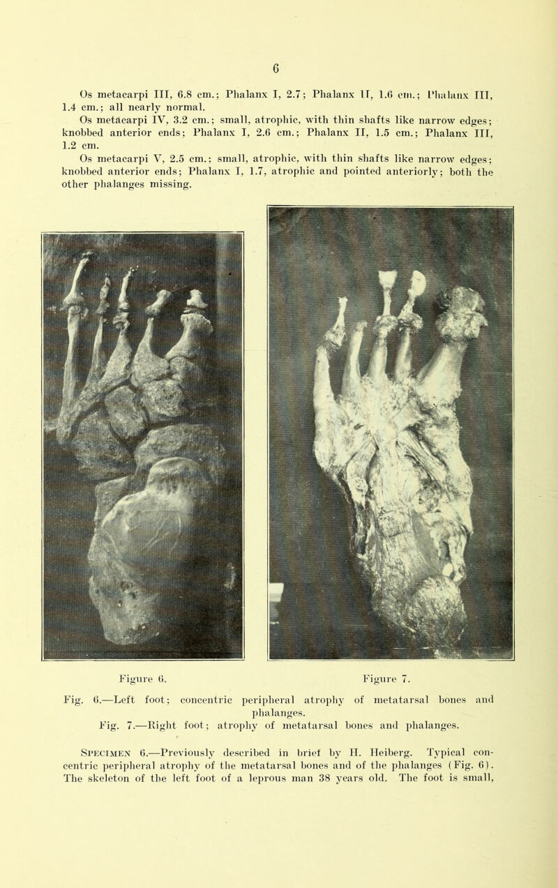 Os metacarpi III, 6.8 cm.; Phalanx I, 2.7; Phalanx IT, 1.6 cm.; Phalanx III, 1.4 cm.; all nearly normal. Os metacarpi IV, 3.2 cm.; small, atrophic, with thin shafts like narrow edges; knobbed anterior ends; Phalanx I, 2.6 cm.; Phalanx II, 1.5 cm.; Phalanx III, 1.2 cm. Os metacarpi V, 2.5 cm.; small, atrophic, with thin shafts like narrow edges; knobbed anterior ends; Phalanx I, 1.7, atrophic and pointed anteriorly; both the other phalanges missing. Figure 6. Figure 7. Fig. 6.—Left foot; concentric peripheral atrophy of metatarsal bones and phalanges. Fig. 7.—Right foot; atrophy of metatarsal bones' and phalanges. Specimen 6.—Previously described in brief by H. Heiberg. Typical con- centric peripheral atrophy of the metatarsal bones and of the phalanges (Fig. 6). The skeleton of the left foot of a leprous man 38 years old. The foot is small,