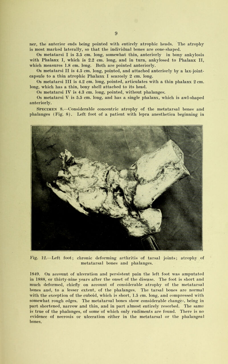 ner, the anterior ends being pointed with entirely atrophic heads. The atrophy is most marked laterally, so that the individual bones are cone-shaped. Os metatarsi I is 3.5 cm. long, somewhat thin, anteriorly in bony ankylosis with Phalanx I, which is 2.2 cm. long, and in turn, ankylosed to Phalanx II, which measures 1.8 cm. long. Both are pointed anteriorly. Os metatarsi II is 4.5 cm. long, pointed, and attached anteriorly by a lax-joint- capsule to a thin atrophic Phalanx I scarcely 2 cm. long. Os metatarsi III is 4.2 cm. long, pointed, articulates with a thin phalanx 2 cm. long, which has a thin, bony shell attached to its head. Os metatarsi IV is 4.3 cm. long, pointed, without phalanges'. Os metatarsi V is 5.5 cm. long, and has a single phalanx, which is awl-shaped anteriorly. Specimen 8.—Considerable concentric atrophy of the metatarsal bones and phalanges (Fig. 8). Left foot of a patient with lepra anesthetica beginning in Fig. 12.—Left foot; chronic deforming arthritis of tarsal joints; atrophy of metatarsal bones and phalanges. 1849. On account of ulceration and persistent pain the left foot was amputated in 1888, or thirty-nine years after the onset of the disease. The foot is short and much deformed, chiefly on account of considerable atrophy of the metatarsal bones and, to a lesser extent, of the phalanges. The tarsal bones are normal with the exception of the cuboid, which is short, 1.5 cm. long, and compressed with somewhat rough edges. The metatarsal bones show considerable change,:, being in part shortened, narrow and thin, and in part almost entirely resorbed. The same is true of the phalanges, of some of which only rudiments are found. There is no evidence of necrosis or ulceration either in the metatarsal or the phalangeal bones.