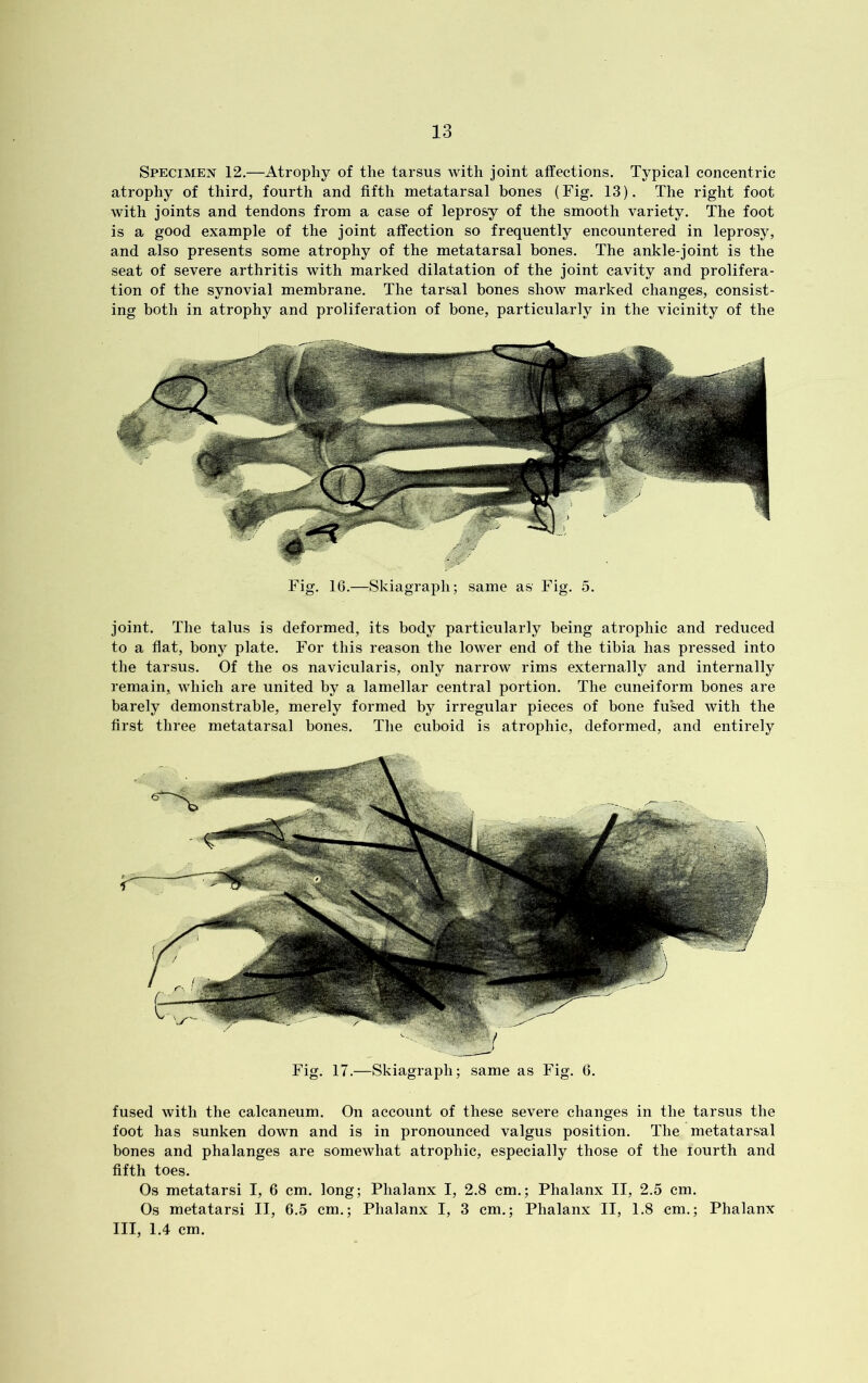 Specimen 12.—Atrophy of the tarsus with joint affections. Typical concentric atrophy of third, fourth and fifth metatarsal bones (Fig. 13). The right foot with joints and tendons from a case of leprosy of the smooth variety. The foot is a good example of the joint affection so frequently encountered in leprosy, and also presents some atrophy of the metatarsal bones. The ankle-joint is the seat of severe arthritis with marked dilatation of the joint cavity and prolifera- tion of the synovial membrane. The tarsal bones show marked changes, consist- ing both in atrophy and proliferation of bone, particularly in the vicinity of the joint. The talus is deformed, its body particularly being atrophic and reduced to a flat, bony plate. For this reason the lower end of the tibia has pressed into the tarsus. Of the os navicularis, only narrow rims externally and internally remain, which are united by a lamellar central portion. The cuneiform bones are barely demonstrable, merely formed by irregular pieces of bone fused with the first three metatarsal bones. The cuboid is atrophic, deformed, and entirely Fig. 17.—Skiagraph; same as Fig. 6. fused with the calcaneum. On account of these severe changes in the tarsus the foot has sunken down and is in pronounced valgus position. The metatarsal bones and phalanges are somewhat atrophic, especially those of the lourth and fifth toes. Os metatarsi I, 6 cm. long; Phalanx I, 2.8 cm.; Phalanx II, 2.5 cm. Os metatarsi II, 6.5 cm.; Phalanx I, 3 cm.; Phalanx II, 1.8 cm.; Phalanx III, 1.4 cm.