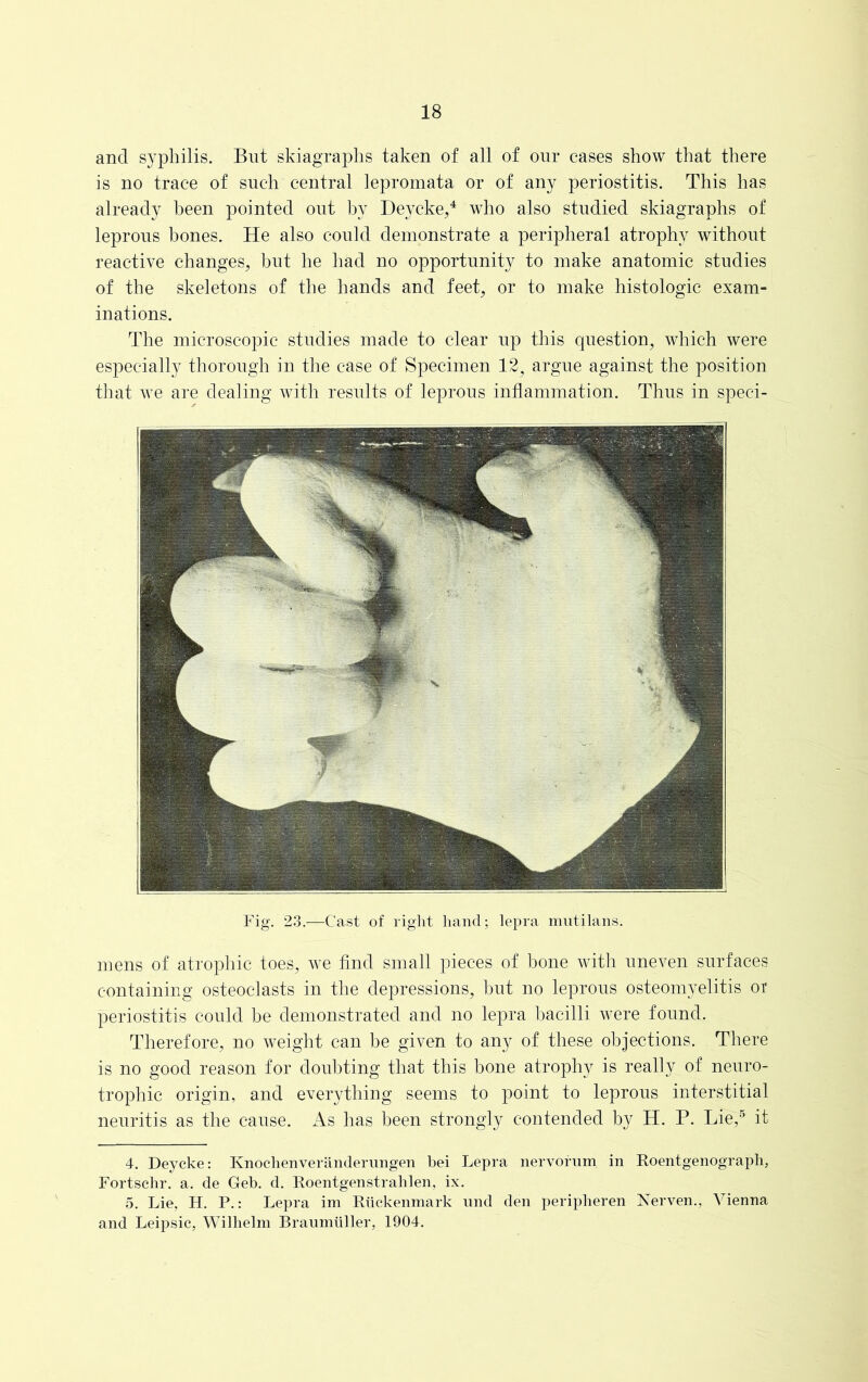 and syphilis. But skiagraphs taken of all of our cases show that there is no trace of such central lepromata or of any periostitis. This has already been pointed out by Deycke,4 who also studied skiagraphs of leprous bones. He also could demonstrate a peripheral atrophy without reactive changes, but he had no opportunity to make anatomic studies of the skeletons of the hands and feet, or to make histologic exam- inations. The microscopic studies made to clear up this question, which were especially thorough in the case of Specimen 12? argue against the position that we are dealing with results of leprous inflammation. Thus in speci- Fig. 23.—Cast of right hand; lepra mutilans. mens of atrophic toes, we find small pieces of bone with uneven surfaces containing osteoclasts in the depressions, but no leprous osteomyelitis ot periostitis could be demonstrated and no lepra bacilli were found. Therefore, no weight can be given to any of these objections. There is no good reason for doubting that this bone atrophy is really of neuro- trophic origin, and everything seems to point to leprous interstitial neuritis as the cause. As has been strongly contended by H. P. Lie,5 it 4. Deycke: Knochenveranderungen bei Lepra nervorum in Eoentgenograph, Fortschr. a. de Geb. d. Eoentgenstrahlen, ix. 5. Lie, H. P.: Lepra im Euckenmark und den peripheren Nerven., Vienna and Leipsic, Wilhelm Braumiiller, 1904.