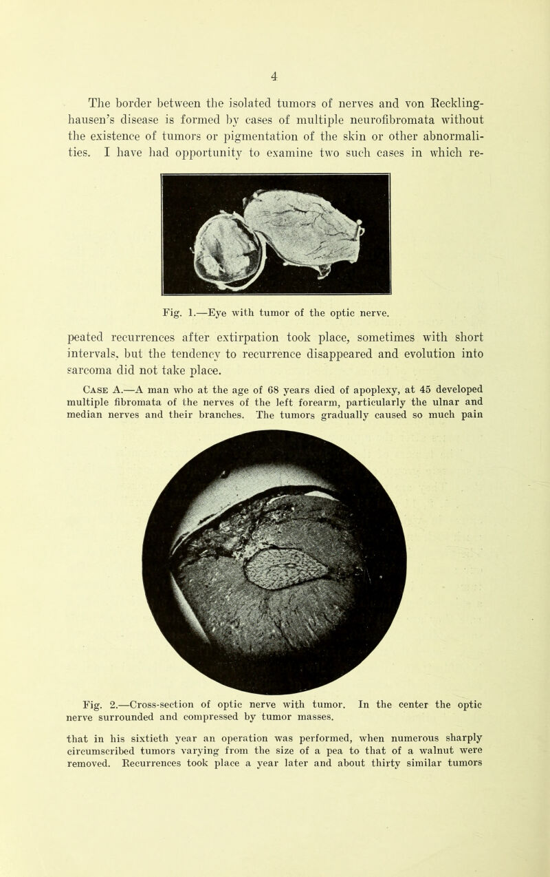 The border between the isolated tumors of nerves and von Keckling- hausen’s disease is formed by cases of multiple neurofibromata without the existence of tumors or pigmentation of the skin or other abnormali- ties. I have had opportunity to examine two such cases in which re- Fig. 1.—Eye with tumor of the optic nerve. peated recurrences after extirpation took place, sometimes with short intervals, but the tendency to recurrence disappeared and evolution into sarcoma did not take place. Case A.—A man who at the age of 68 years died of apoplexy, at 45 developed multiple fibromata of the nerves of the left forearm, particularly the ulnar and median nerves and their branches. The tumors gradually caused so much pain Fig. 2.—Cross-section of optic nerve with tumor. In the center the optic nerve surrounded and compressed by tumor masses. that in his sixtieth year an operation was performed, when numerous sharply circumscribed tumors varying from the size of a pea to that of a walnut were removed. ^Recurrences took place a year later and about thirty similar tumors