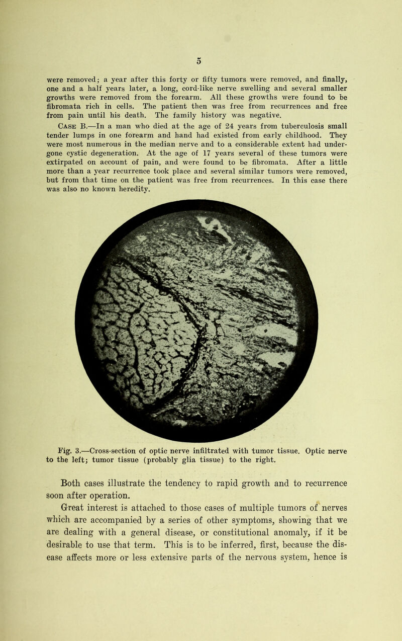 were removed; a year after this forty or fifty tumors were removed, and finally, one and a half years later, a long, cord-like nerve swelling and several smaller growths were removed from the forearm. All these growths were found to be fibromata rich in cells. The patient then was free from recurrences and free from pain until his death. The family history was negative. Case B.—In a man who died at the age of 24 years from tuberculosis small tender lumps in one forearm and hand had existed from early childhood. They were most numerous in the median nerve and to a considerable extent had under- gone cystic degeneration. At the age of 17 years several of these tumors were extirpated on account of pain, and were found to be fibromata. After a little more than a year recurrence took place and several similar tumors were removed, but from that time on the patient was free from recurrences. In this case there was also no known heredity. Fig. 3.—Cross-section of optic nerve infiltrated with tumor tissue. Optic nerve to the left; tumor tissue (probably glia tissue) to the right. Both cases illustrate the tendency to rapid growth and to recurrence soon after operation. Great interest is attached to those cases of multiple tumors of nerves which are accompanied by a series of other symptoms, showing that we are dealing with a general disease, or constitutional anomaly, if it be desirable to use that term. This is to be inferred, first, because the dis- ease affects more or less extensive parts of the nervous system, hence is