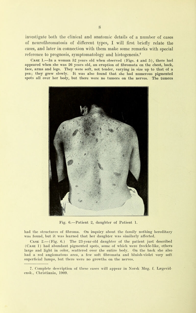 investigate both the clinical and anatomic details of a number of cases of neurofibromatosis of different types, I will first briefly relate the cases, and later in connection with them make some remarks with special reference to prognosis, symptomatology and histogenesis.7 Case 1.—In a woman 52 years old when observed (Figs. 4 and 5), there had appeared when she was 26 years old, an eruption of fibromata on the chest, back, face, arms and legs. They were soft, not tender, varying in size up to that of a pea; they grew slowly. It was also found that she had numerous pigmented spots all over her body, but there were no tumors on the nerves. The tumors had the structures of fibroma. On inquiry about the family nothing hereditary was found, but it was learned that her daughter was similarly affected. Case 2.— (Fig. 6.) The 23-year-old daughter of the patient just described (Case 1) had abundant pigmented spots, some of which were freckle-like, others large and light in color, scattered over the entire body. On the back she also had a red angiomatous area, a few soft fibromata and bluish-violet very soft superficial lumps, but there were no growths on the nerves. ensk., Christiania, 1909. Fig. 6.—Patient 2, daughter of Patient 1.