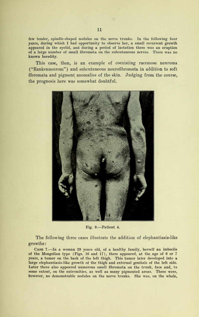few tender, spindle-shaped nodules on the nerve trunks. In the following four years, during which I had opportunity to observe her, a small recurrent growth appeared in the eyelid, and during a period of lactation there was an eruption of a large number of small fibromata on the subcutaneous nerves. There was no known heredity. This case, then, is an example of coexisting racemose neuroma (“Rankenneurom”) and subcutaneous neurofibromata in addition to soft fibromata and pigment anomalies of the skin. Judging from the course, the prognosis here was somewhat doubtful. Fig. 9.—Patient 4. The following three cases illustrate the addition of elephantiasis-like growths: Case 7.—In a woman 29 years old, of a healthy family, herself an imbecile of the Mongolian type (Figs. 16 and 17), there appeared, at the age of 6 or 7 years, a tumor on the back of the left thigh. This tumor later developed into a large elephantiasis-like growth of the thigh and external genitals of the left side. Later there also appeared numerous small fibromata on the trunk, face and, to some extent, on the extremities, as well as many pigmented areas. There were, however, no demonstrable nodules on the nerve trunks. She was, on the whole.