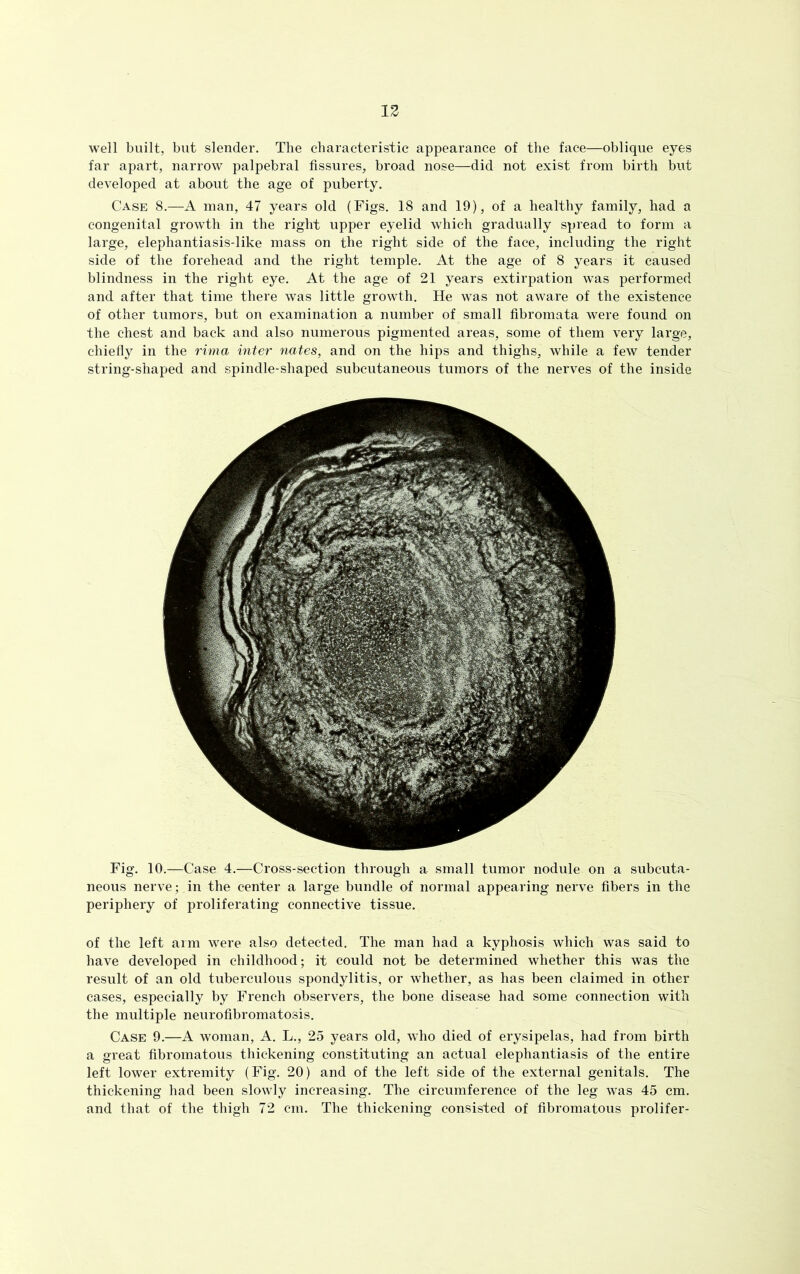 well built, but slender. The characteristic appearance of the face—oblique eyes far apart, narrow palpebral fissures, broad nose—did not exist from birth but developed at about the age of puberty. Case 8.—A man, 47 years old (Figs. 18 and 19), of a healthy family, had a congenital growth in the right upper eyelid which gradually spread to form a large, elephantiasis-like mass on the right side of the face, including the right side of the forehead and the right temple. At the age of 8 years it caused blindness in the right eye. At the age of 21 years extirpation was performed and after that time there was little growth. He was not aware of the existence of other tumors, but on examination a number of small fibromata were found on the chest and back and also numerous pigmented areas, some of them very large, chiefly in the rima inter nates, and on the hips and thighs, while a few tender string-shaped and spindle-shaped subcutaneous tumors of the nerves of the inside Fig. 10.—Case 4.—Cross-section through a small tumor nodule on a subcuta- neous nerve ; in the center a large bundle of normal appearing nerve fibers in the periphery of proliferating connective tissue. of the left arm were also detected. The man had a kyphosis which was said to have developed in childhood; it could not be determined whether this was the result of an old tuberculous spondylitis, or whether, as has been claimed in other cases, especially by French observers, the bone disease had some connection with the multiple neurofibromatosis. Case 9.—A woman, A. L., 25 years old, who died of erysipelas, had from birth a great fibromatous thickening constituting an actual elephantiasis of the entire left lower extremity (Fig. 20) and of the left side of the external genitals. The thickening had been slowly increasing. The circumference of the leg was 45 cm. and that of the thigh 72 cm. The thickening consisted of fibromatous prolifer-