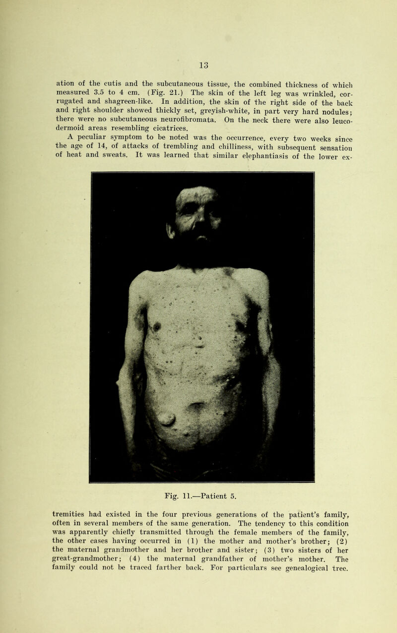 tremities had existed in the four previous generations of the patient’s family, often in several members of the same generation. The tendency to this condition was apparently chiefly transmitted through the female members of the family, the other cases having occurred in (1) the mother and mother’s brother; (2) the maternal grandmother and her brother and sister; (3) two sisters of her great-grandmother; (4) the maternal grandfather of mother’s mother. The family could not be traced farther back. For particulars see genealogical tree. ation of the cutis and the subcutaneous tissue, the combined thickness of which measured 3.5 to 4 cm. (Fig. 21.) The skin of the left leg was wrinkled, cor- rugated and shagreen-like. In addition, the skin of the right side of the back and right shoulder showed thickly set, greyish-white, in part very hard nodules; there were no subcutaneous neurofibromata. On the neck there were also leuco- dermoid areas resembling cicatrices. A peculiar symptom to be noted was the occurrence, every two weeks since the age of 14, of attacks of trembling and chilliness, with subsequent sensation of heat and sweats. It was learned that similar elephantiasis of the lower ex-