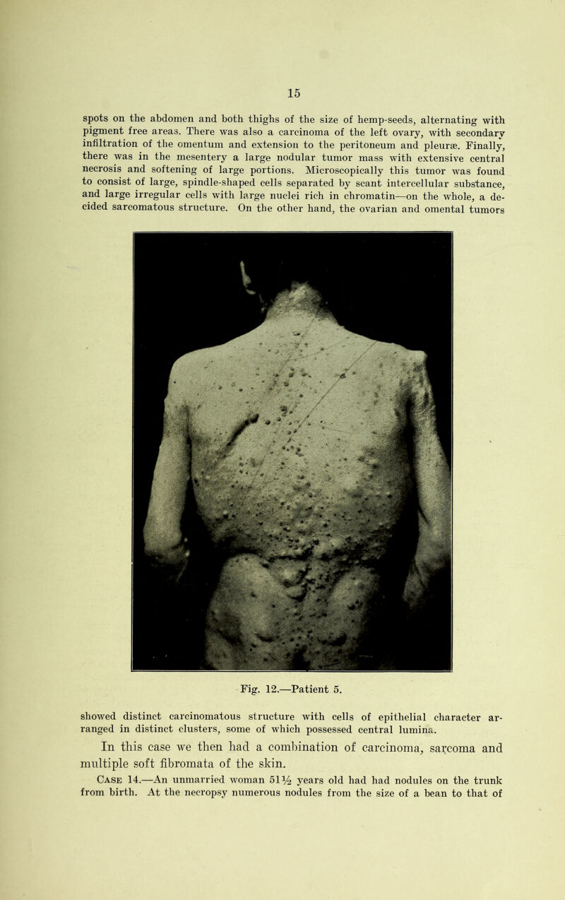 spots on the abdomen and both thighs of the size of hemp-seeds, alternating with pigment free areas. There was also a carcinoma of the left ovary, with secondary infiltration of the omentum and extension to the peritoneum and pleurae. Finally, there was in the mesentery a large nodular tumor mass with extensive central necrosis and softening of large portions. Microscopically this tumor was found to consist of large, spindle-shaped cells separated by scant intercellular substance, and large irregular cells with large nuclei rich in chromatin—on the whole, a de- cided sarcomatous structure. On the other hand, the ovarian and omental tumors Fig. 12.—Patient 5. showed distinct carcinomatous structure with cells of epithelial character ar- ranged in distinct clusters, some of which possessed central lumina. In this case we then had a combination of carcinoma, sarcoma and multiple soft fibromata of the skin. Case 14.—An unmarried woman 51 y2 years old had had nodules on the trunk from birth. At the necropsy numerous nodules from the size of a bean to that of