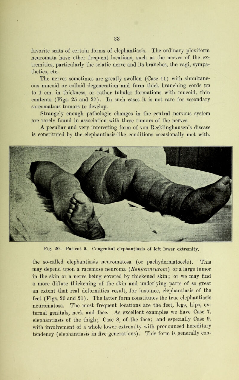 favorite seats of certain forms of elephantiasis. The ordinary plexiform neuromata have other frequent locations, such as the nerves of the ex- tremities, particularly the sciatic nerve and its branches, the vagi, sympa- thetics, etc. The nerves sometimes are greatly swollen (Case 11) with simultane- ous mucoid or colloid degeneration and form thick branching cords up to 1 cm. in thickness, or rather tubular formations with mucoid, thin contents (Figs. 25 and 27). In such cases it is not rare for secondary sarcomatous tumors to develop. Strangely enough pathologic changes in the central nervous system are rarely found in association with these tumors of the nerves. A peculiar and very interesting form of von Recklinghausen’s disease is constituted by the elephantiasis-like conditions occasionally met with, Fig. 20.—Patient 9. Congenital elephantiasis of left lower extremity. the so-called elephantiasis neuromatosa (or pachydermatocele). This may depend upon a racemose neuroma (RanJcenneurom) or a large tumor in the skin or a nerve being covered by thickened skin; or we may find a more diffuse thickening of the skin and underlying parts of so great an extent that real deformities result, for instance, elephantiasis of the feet (Figs. 20 and 21). The latter form constitutes the true elephantiasis neuromatosa. The most frequent locations are the feet, legs, hips, ex- ternal genitals, neck and face. As excellent examples we have Case 7, elephantiasis of the thigh; Case 8, of the face; and especially Case 9, with involvement of a whole lower extremity with pronounced hereditary tendency (elephantiasis in five generations). This form is generally con-