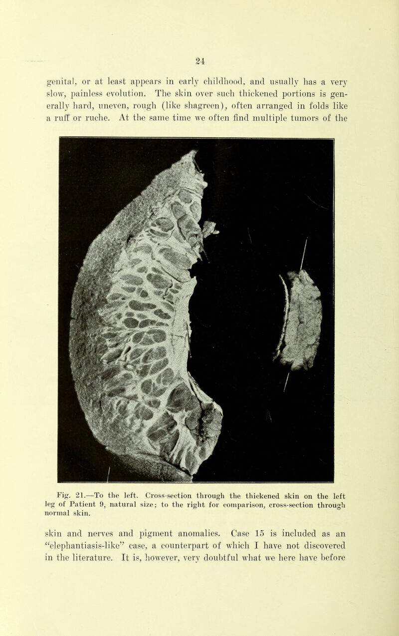 genital, or at least appears in early childhood, and usually has a very slow, painless evolution. The skin over such thickened portions is gen- erally hard, uneven, rough (like shagreen), often arranged in folds like a ruff or ruche. At the same time we often find multiple tumors of the Fig. 21.—To the left. Cross-section through the thickened skin on the left leg of Patient 9, natural size; to the right for comparison, cross-section through normal skin. skin and nerves and pigment anomalies. Case 15 is included as an “elephantiasis-like” case, a counterpart of which I have not discovered in the literature. It is, however, very doubtful what we here have before