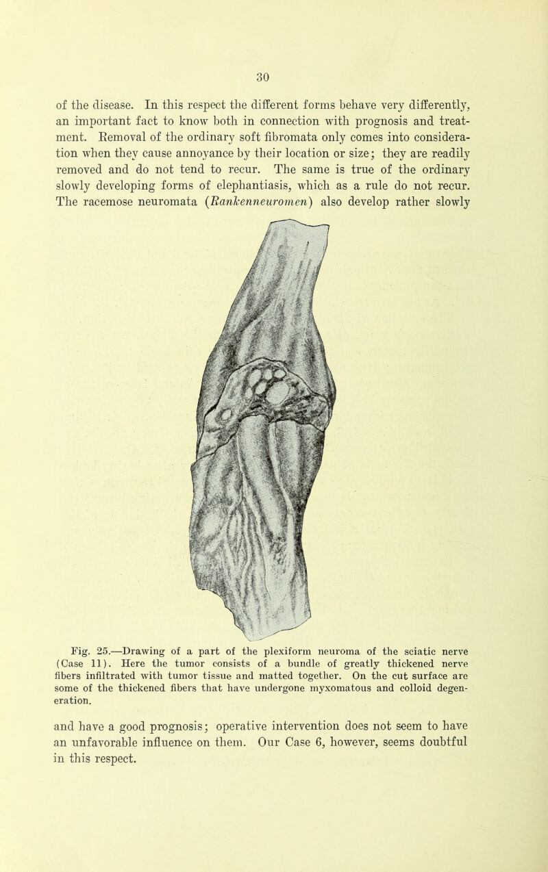 of the disease. In this respect the different forms behave very differently, an important fact to know both in connection with prognosis and treat- ment. Removal of the ordinary soft fibromata only comes into considera- tion when they cause annoyance by their location or size; they are readily removed and do not tend to recur. The same is true of the ordinary slowly developing forms of elephantiasis, which as a rule do not recur. The racemose neuromata (Ranlcenneuromen) also develop rather slowly Fig. 25.—Drawing of a part of the plexiform neuroma of the sciatic nerve (Case 11). Here the tumor consists of a bundle of greatly thickened nerve fibers infiltrated with tumor tissue and matted together. On the cut surface are some of the thickened fibers that have undergone myxomatous and colloid degen- eration. and have a good prognosis; operative intervention does not seem to have an unfavorable influence on them. Our Case 6, however, seems doubtful in this respect.