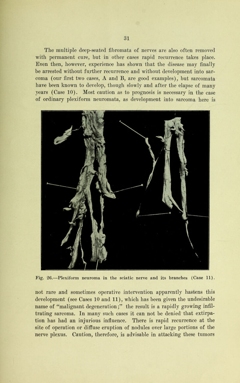 The multiple deep-seated fibromata of nerves are also often removed with permanent cure, but in other cases rapid recurrence takes place. Even then, however, experience has shown that the disease may finally be arrested without further recurrence and without development into sar- coma (our first two cases, A and B, are good examples), but sarcomata have been known to develop, though slowly and after the elapse of many years (Case 10). Most caution as to prognosis is necessary in the case of ordinary plexiform neuromata, as development into sarcoma here is Fig. 26.—Plexiform neuroma in the sciatic nerve and its branches (Case 11). not rare and sometimes operative intervention apparently hastens this development (see Cases 10 and 11), which has been given the undesirable name of “malignant degeneration ;” the result is a rapidly growing infil- trating sarcoma. In many such cases it can not be denied that extirpa- tion has had an injurious influence. There is rapid recurrence at the site of operation or diffuse eruption of nodules over large portions of the nerve plexus. Caution, therefore, is advisable in attacking these tumors