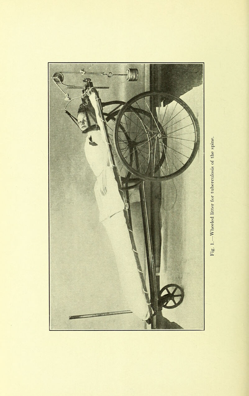 r .Sf -Wheeled litter for tuberculosis of the spine.