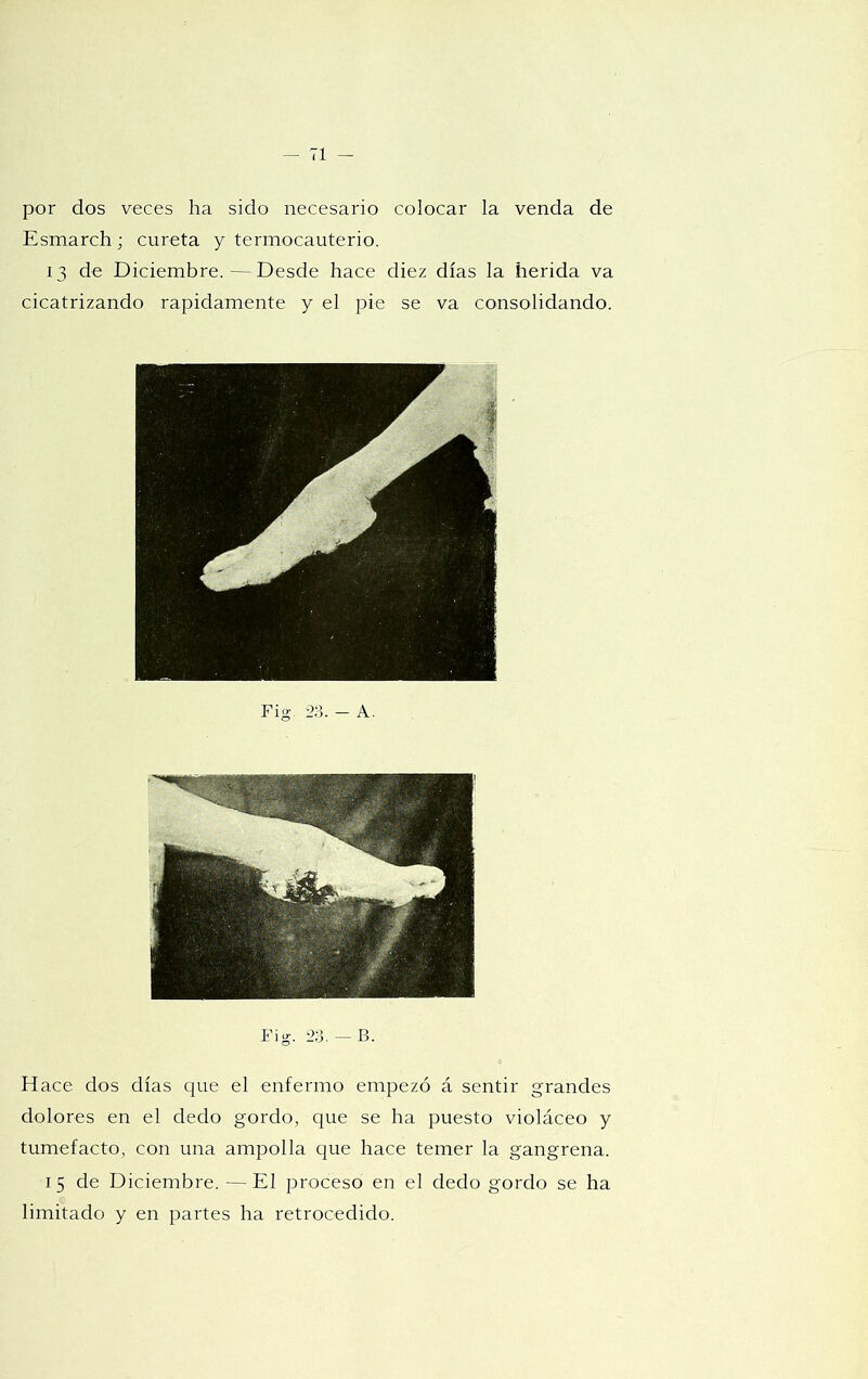 por dos veces ha sido necesario colocar la venda de Esmarch; careta y termocauterio. 13 de Diciembre.—Desde hace diez días la herida va cicatrizando rápidamente y el pie se va consolidando. Fig. i>3. — B. Hace dos días cpie el enfermo empezó á sentir grandes dolores en el dedo gordo, que se ha puesto violáceo y tumefacto, con una ampolla que hace temer la gangrena. 15 de Diciembre. —El proceso en el dedo gordo se ha limitado y en partes ha retrocedido.