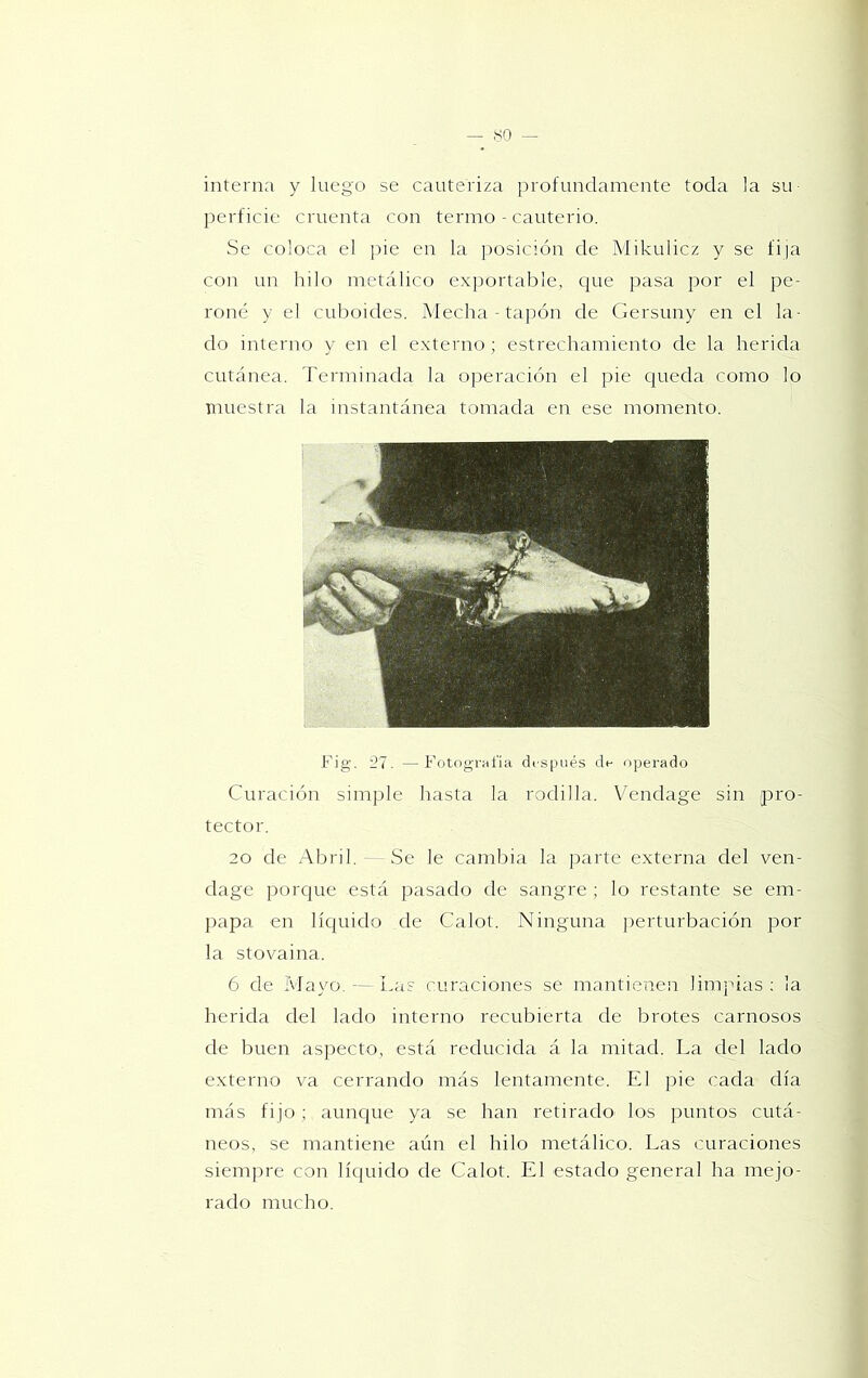 interna y luego se cauteriza profundamente toda la su- perficie cruenta con termo - cauterio. Se coloca el pie en la posición de Mikulicz y se fija con un hilo metálico exportable, que pasa por el pe- roné y el cuboides. Mecha-tapón de Gersuny en el la- do interno y en el externo ; estrechamiento de la herida cutánea. Terminada la ojreración el pie queda como lo muestra la instantánea tomada en ese momento. Fig. '21. —Fotografía después de operado Curación simple hasta la rodilla. Vendage sin pro- tector. 20 de Abril. - Se le cambia la parte externa del ven- dage porque está pasado de sangre ; lo restante se em- papa en líquido de Calot. Ninguna i)erturbación por la st oval na. 6 de Mayo.—Las curaciones se mantienen linijuas ; ¡a herida del lado interno recubierta de brotes carnosos de buen asjrecto, está reducida á la mitad. La del lado e.xterno va cerrando más lentamente. El pie cada día más fijo ; aunque ya se han retirado los puntos cutá- neos. se mantiene aún el hilo metálico. Las curaciones siempre con lícpiido de Calot. El estado general ha mejo- rado mucho.