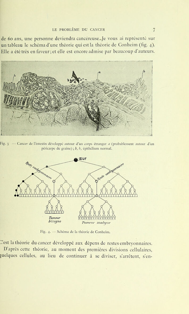 / de éo ans, une personne deviendra cancéreuse.Je vous ai représenté sur un tableau le schéma d'une théorie qui est la théorie de Conheim (fig. 4). Elle a été très en faveur; et elle est encore admise par beaucoup d’auteurs. tig. 3 — Cancer de l’intestin développé autour d’un corps étranger a (probablement autour d’un péricarpe de graine) ; b, b, épithélium normal. ^ est la théorie du cancer développé aux dépens de restes embryonnaires. D’après cette théorie, au moment des premières divisions cellulaires, quelques cellules, au lieu de continuer à se diviser, s’arrêtent, s’en-